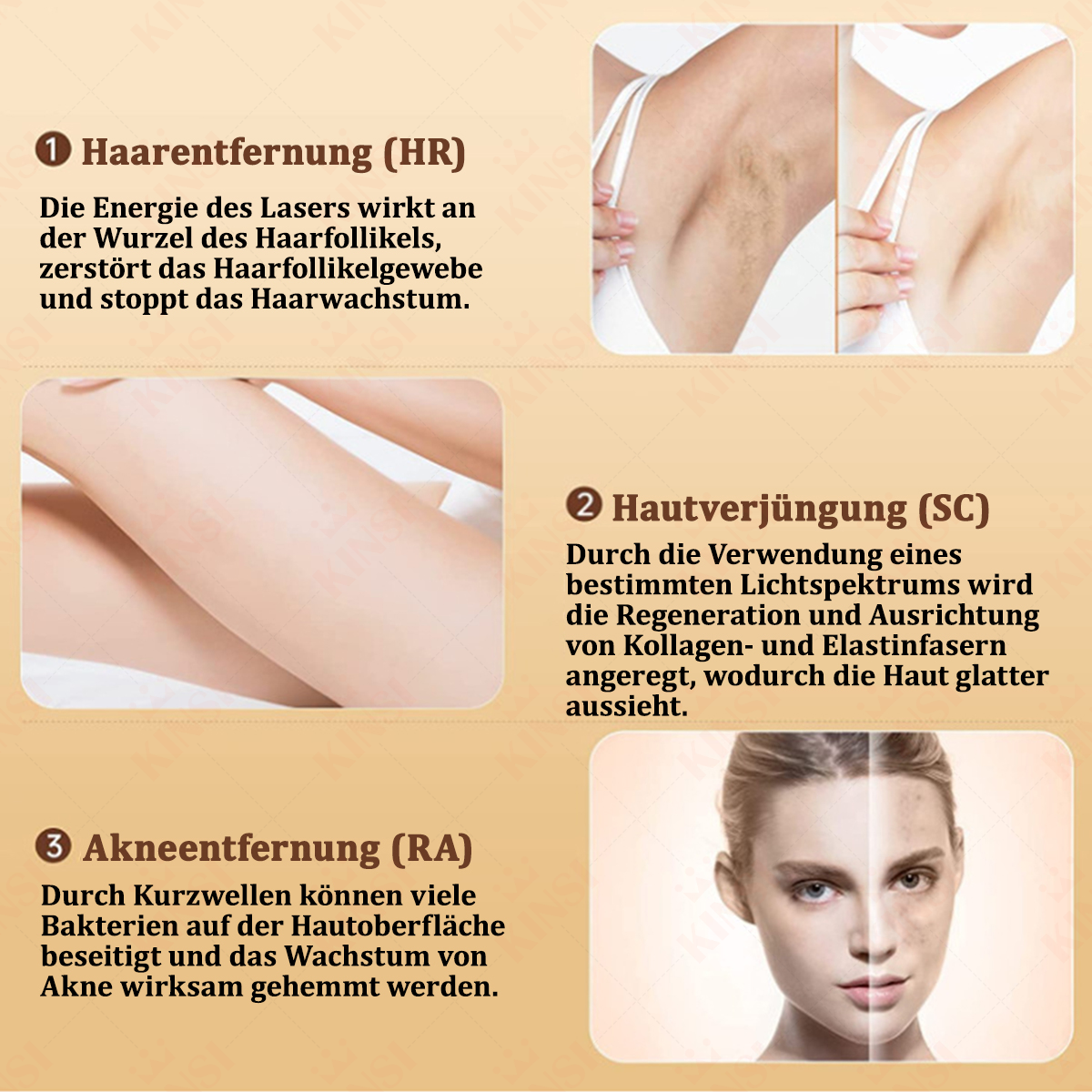 Diagramme, die die Auswirkungen eines Laser-Haarentfernungsgeräts zeigen. Es zeigt Haarentfernung, Hautverjüngung und Akneentfernung.