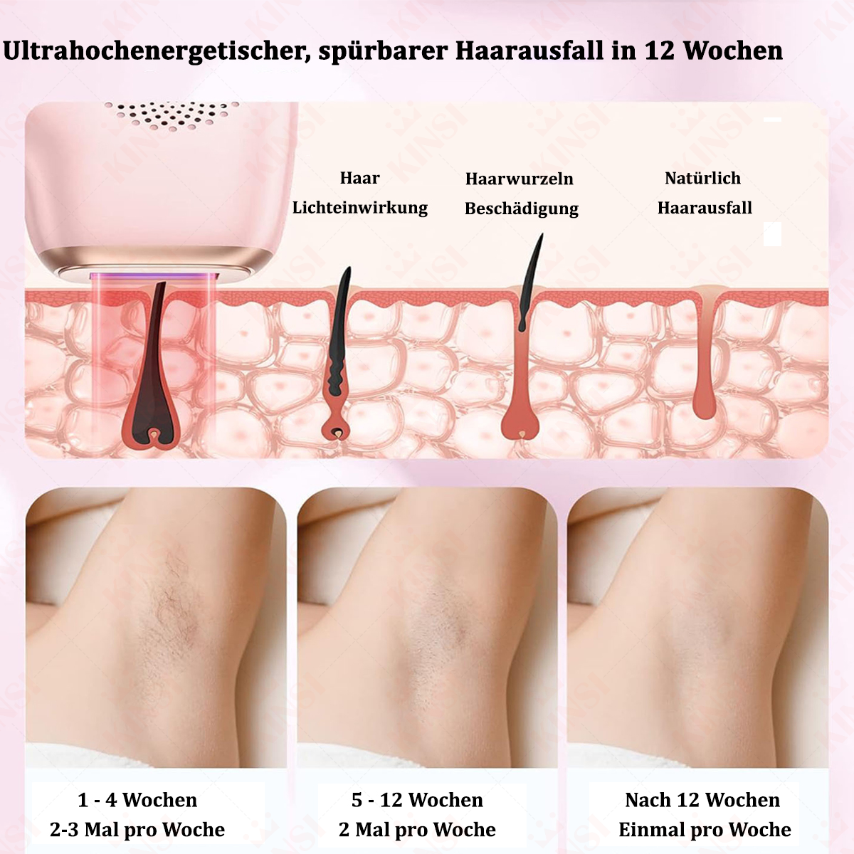 Ein Diagramm zur Haarentfernung mit einem Gerät, mit Bildern, die Vorher-Nachher-Effekte im Laufe der Zeit zeigen.