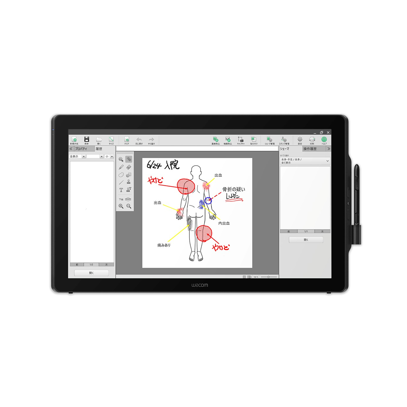 Un tablet Wacom mostra un diagramma di una figura umana con annotazioni mediche, tra cui etichette per lesioni e termini medici.
