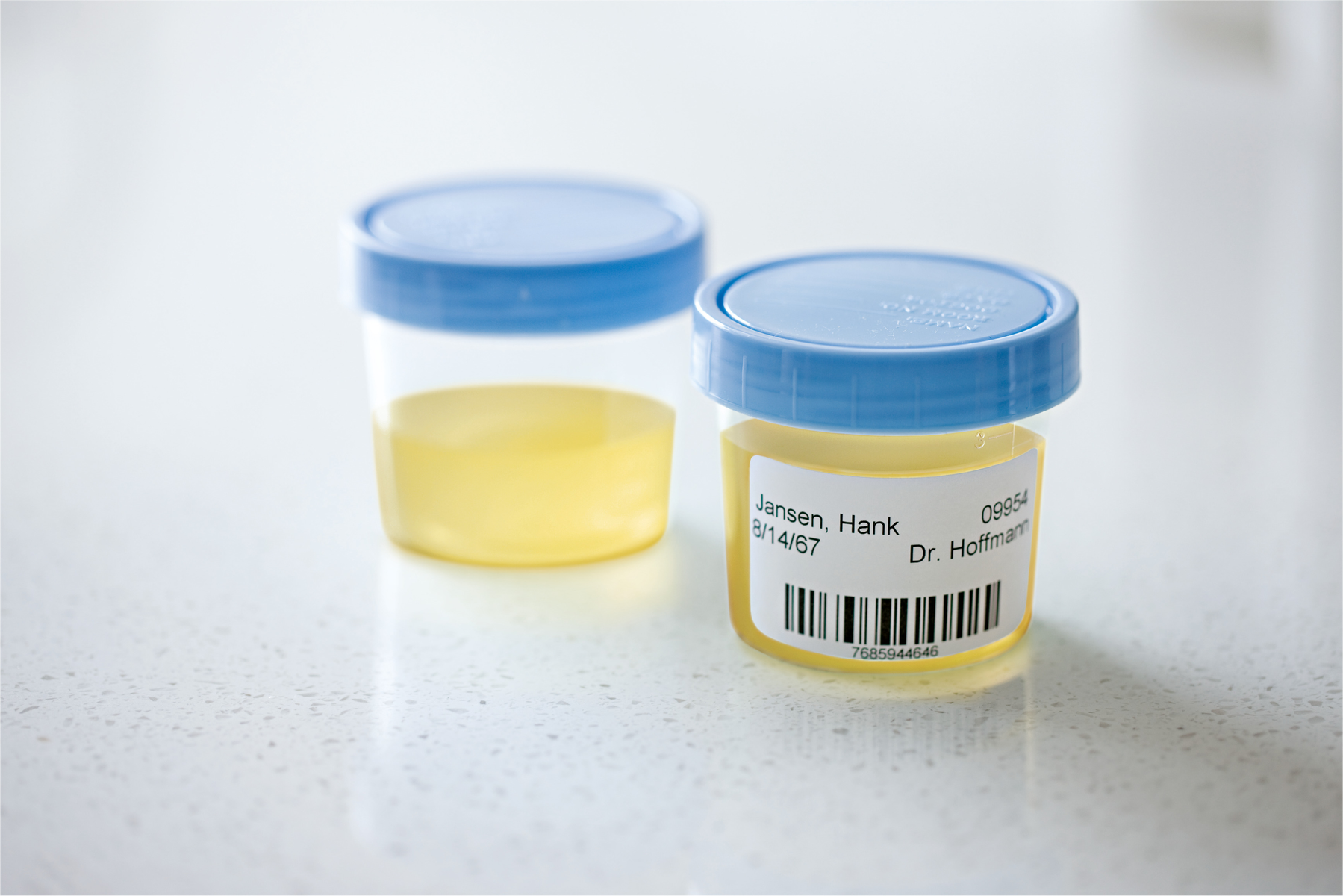 Zwei transparente Plastikbehälter mit blauen Deckeln. Einer enthält Urin, der andere hat ein Etikett.