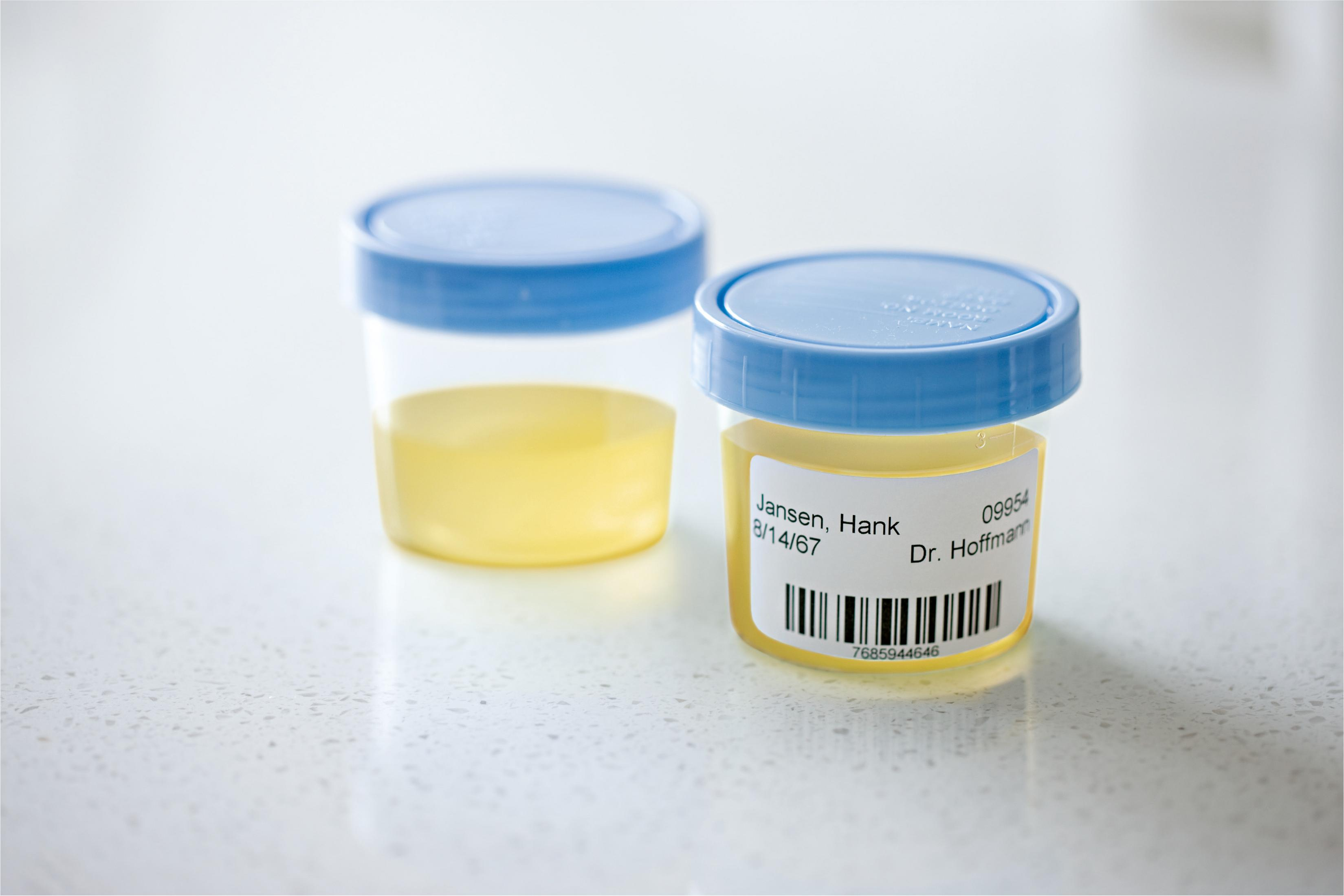 Zwei transparente Plastikbehälter mit blauen Deckeln. Einer enthält Urin, der andere hat ein Etikett.