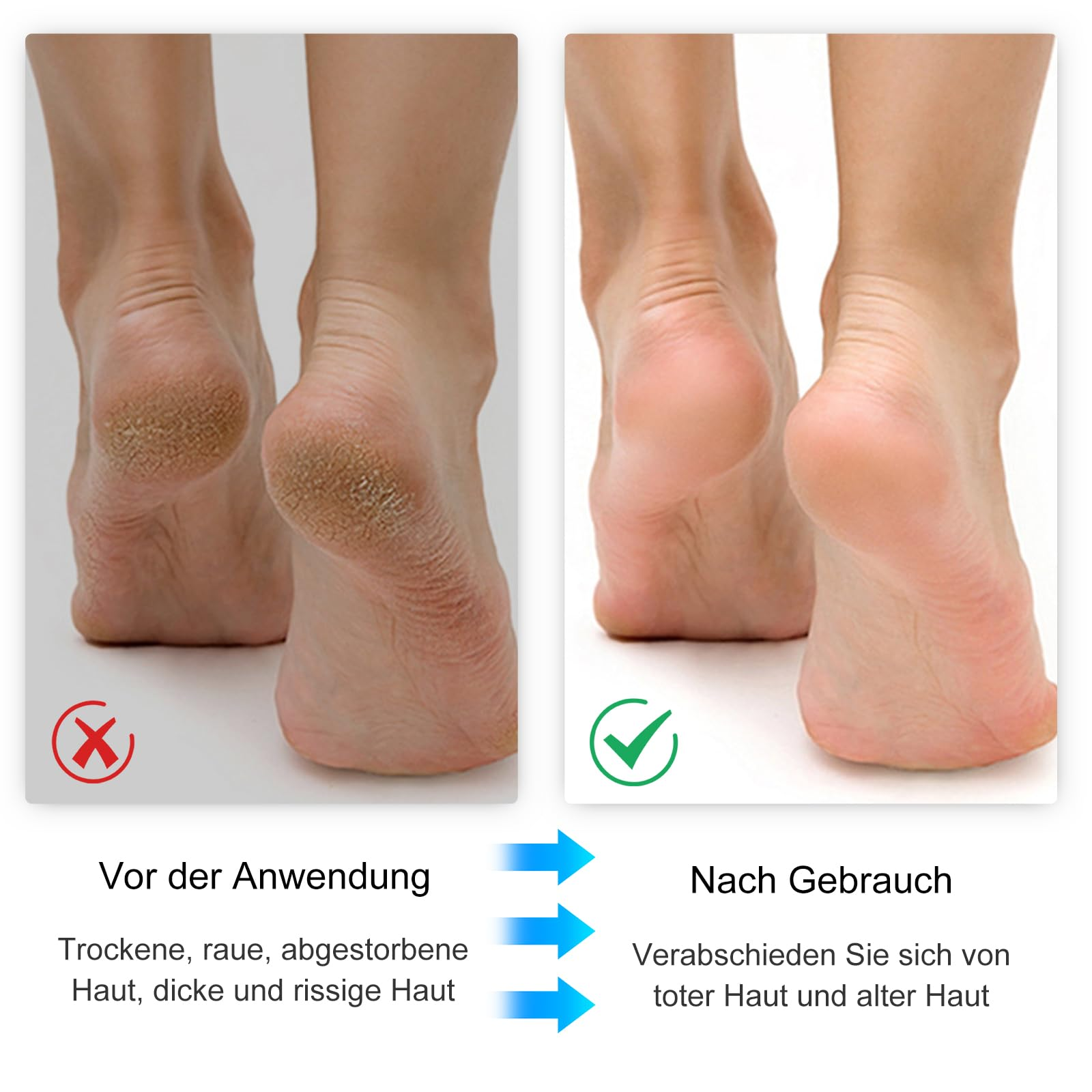Vorher-Nachher-Bilder von Füßen, die die Verbesserung nach der Verwendung eines Fußpflegeprodukts zeigen.