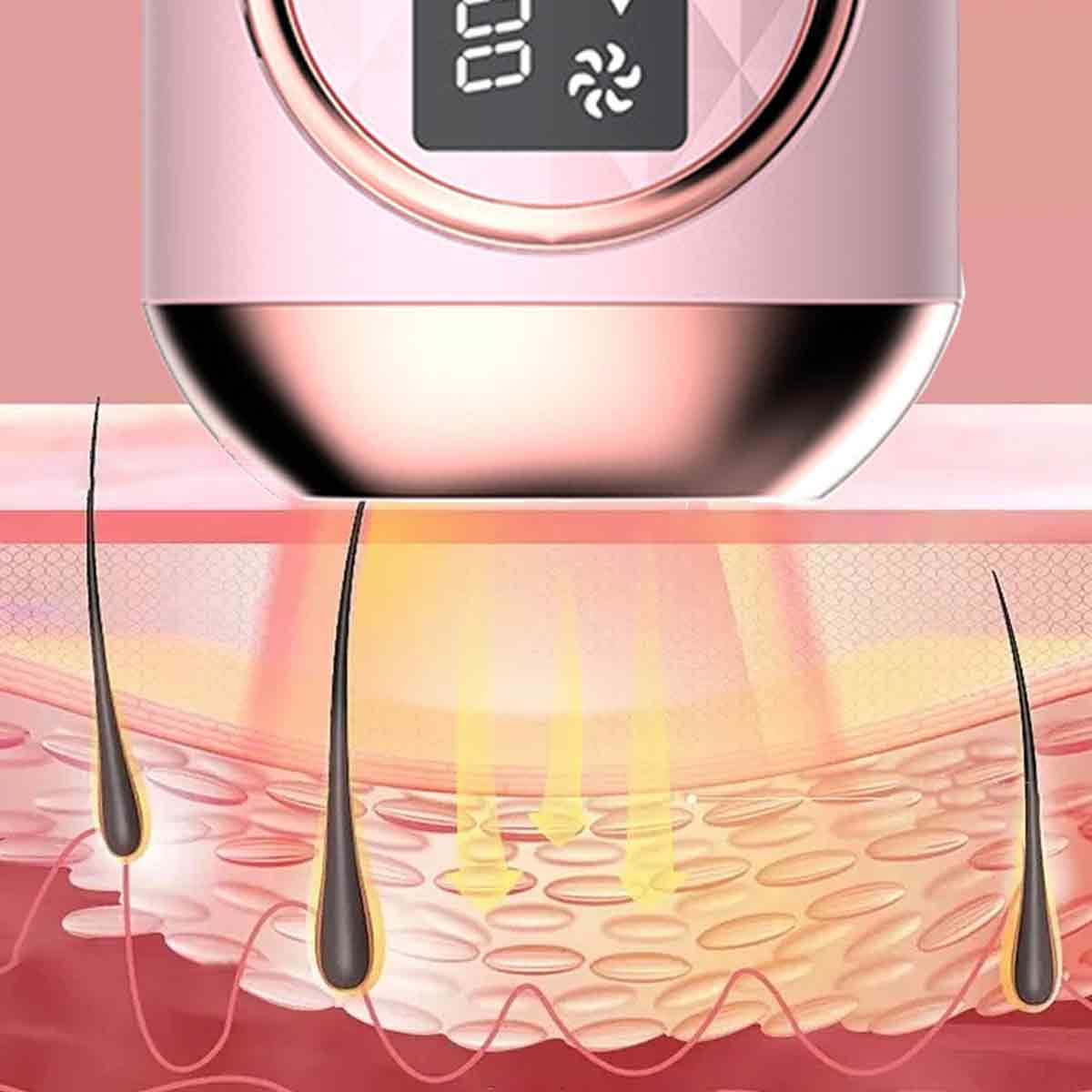 Diagramm der Haut mit Haarfollikeln und einem rosa Epilierer. Gelbe Energiestrahlen zielen auf die Follikel zur Haarentfernung.