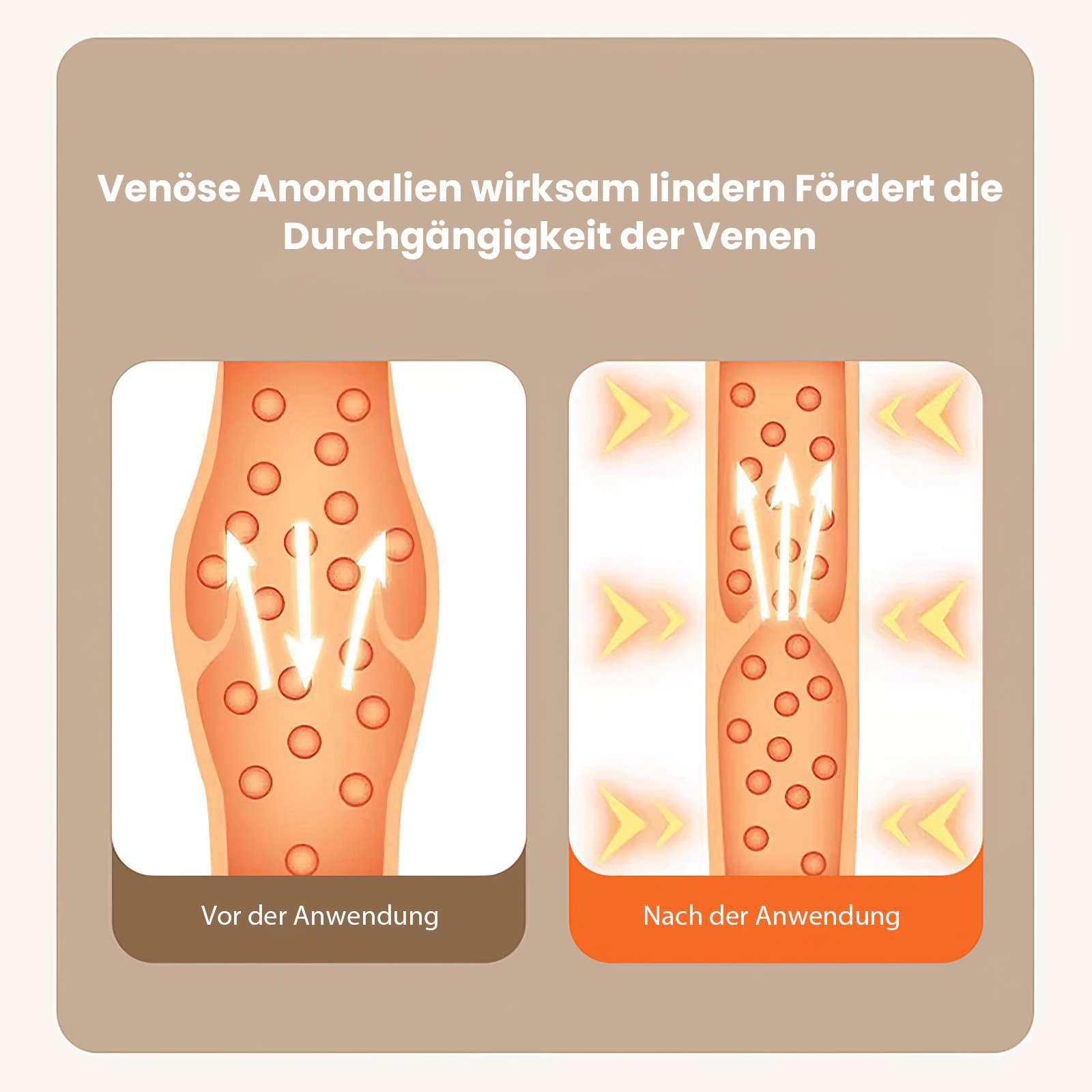 Eine Illustration zeigt Venen vor und nach der Behandlung. Pfeile weisen auf verbesserte Durchblutung hin. Venen sind orange mit roten Kreisen.