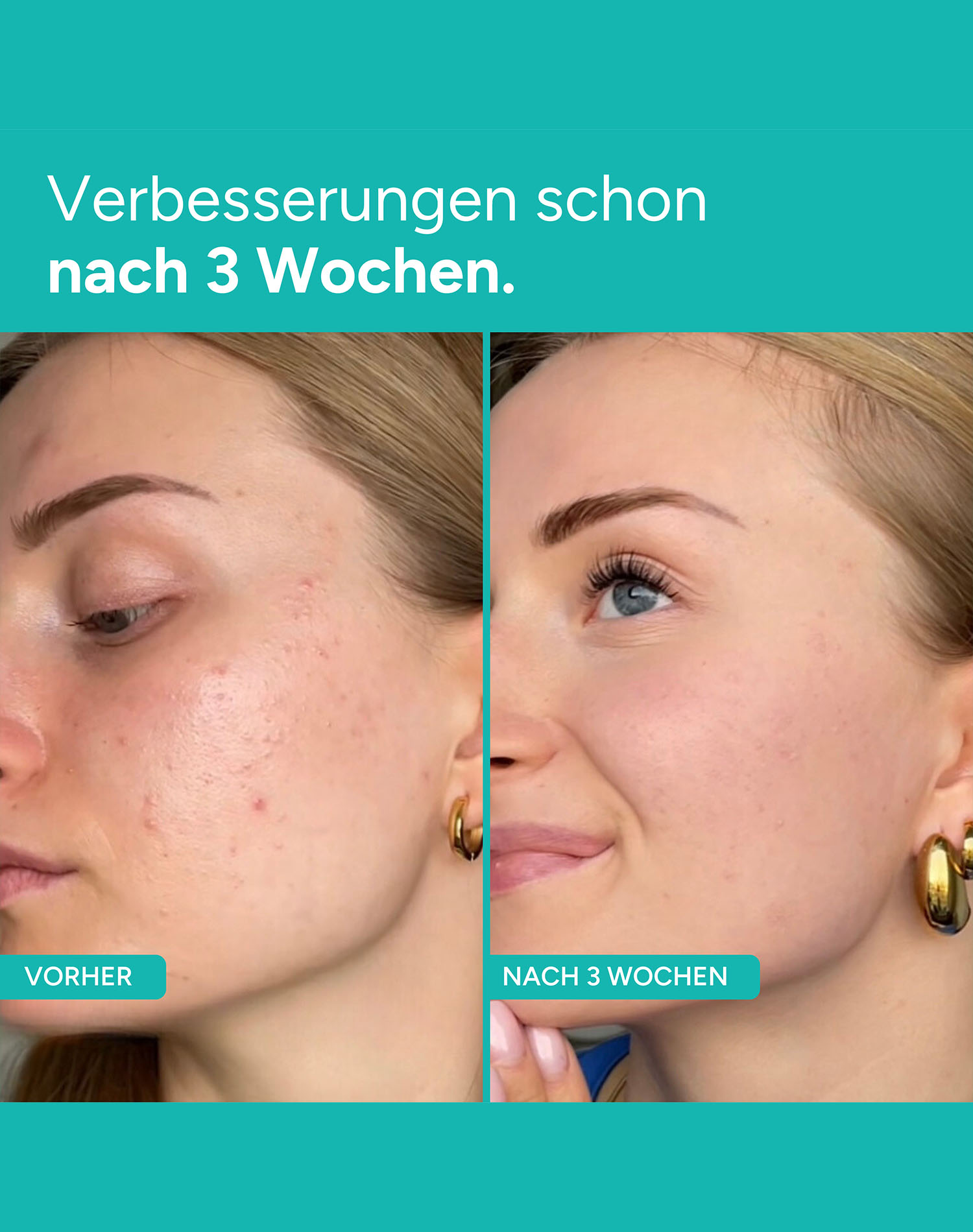 Vergleich des Gesichts einer Frau vor und nach 3 Wochen Behandlung. 'Vorher' zeigt Akne, 'Nachher' zeigt verbesserte Haut.