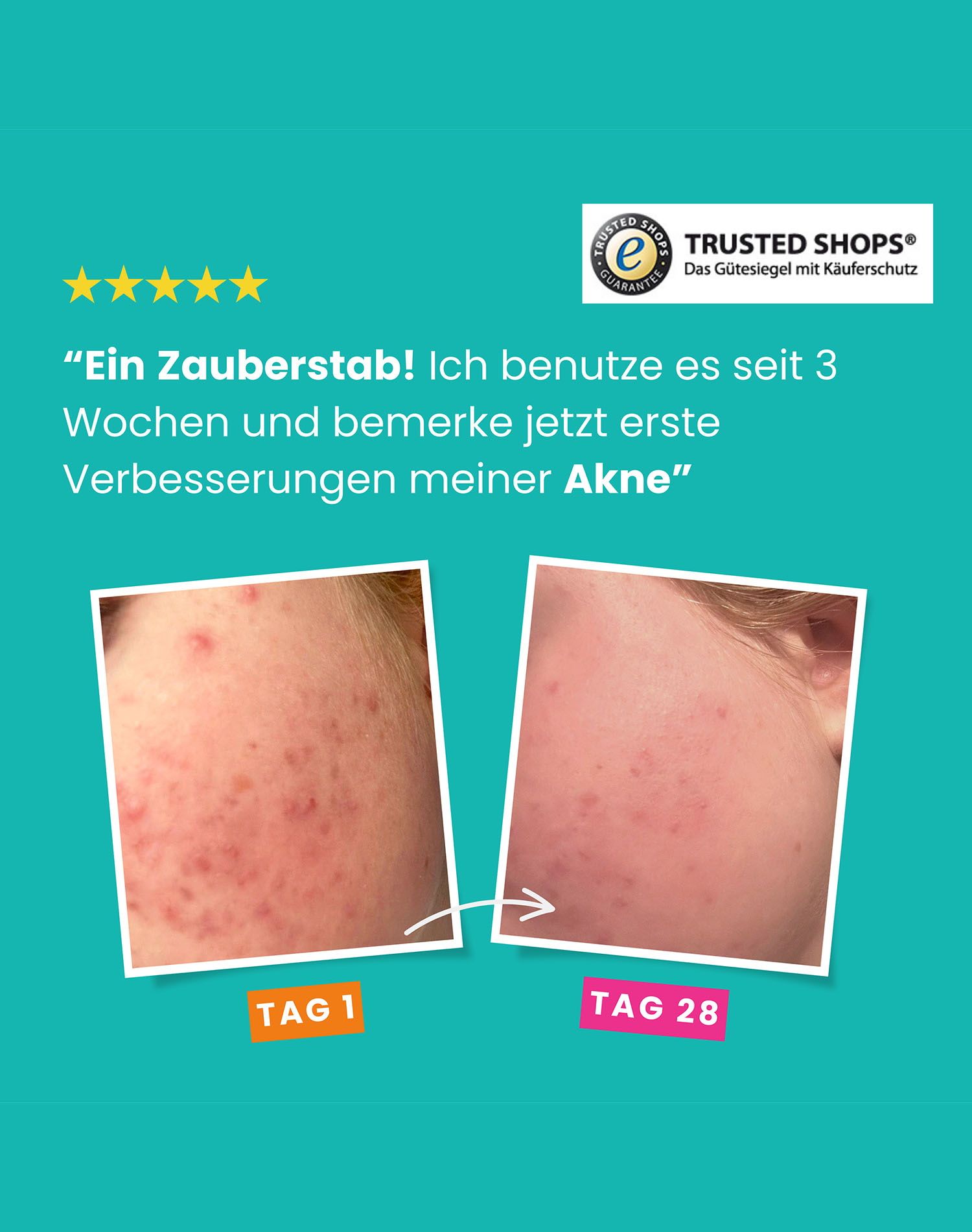 Das Bild zeigt Haut mit Akne vor und nach der Behandlung. Das Vorher-Bild, 'TAG 1', zeigt rote Flecken. Das Nachher-Bild, 'TAG 28', zeigt klarere Haut.
