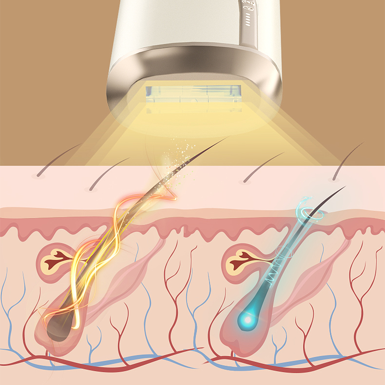 Diagramm der Laser-Haarentfernung. Gerät emittiert Licht auf die Haut. Haarfollikel und Haar werden hervorgehoben, zeigen Vorher-Nachher-Effekt.