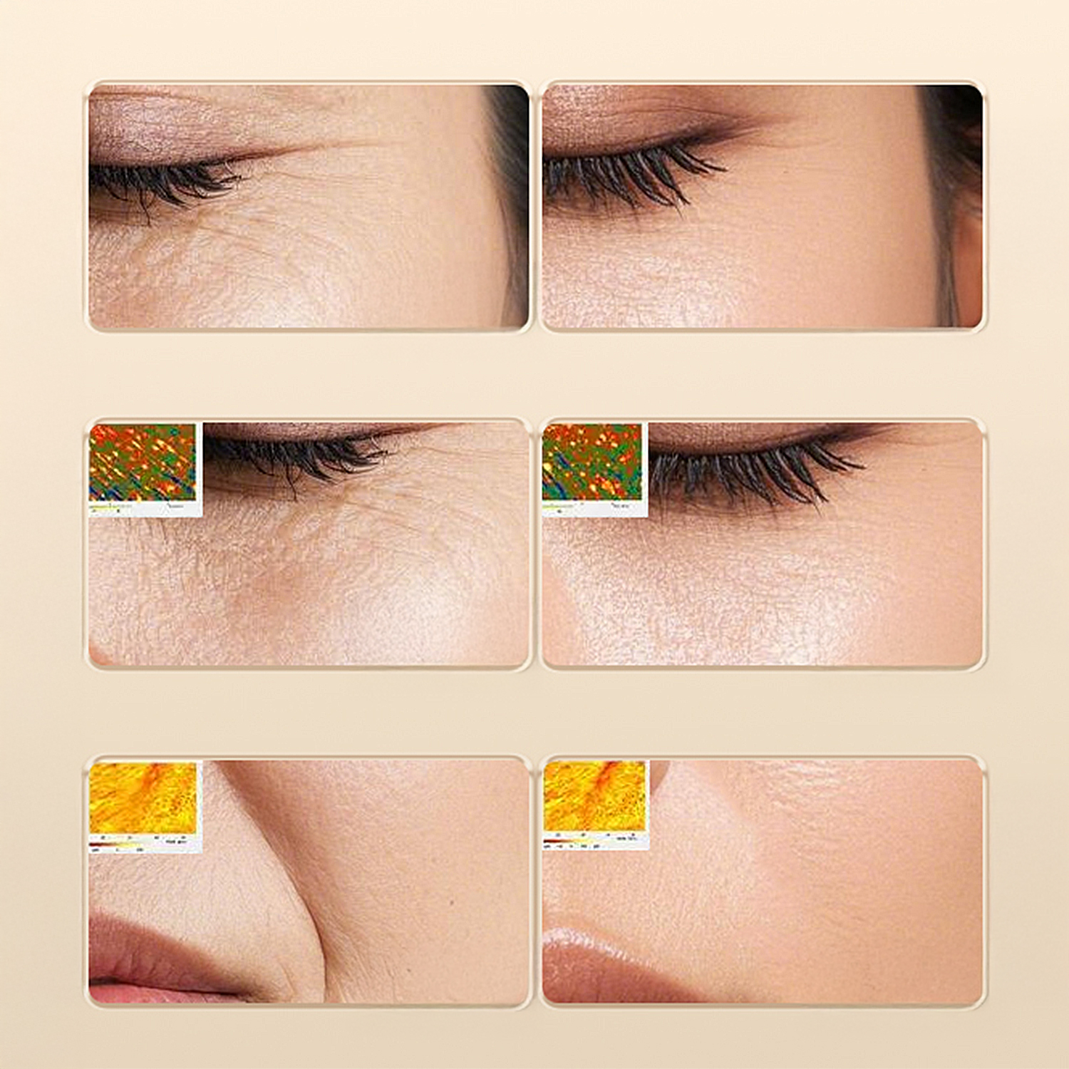 Primer plano del área de los ojos de una persona. Muestra fotos del antes y el después con arrugas y piel más lisa. También se incluyen gráficos pequeños.