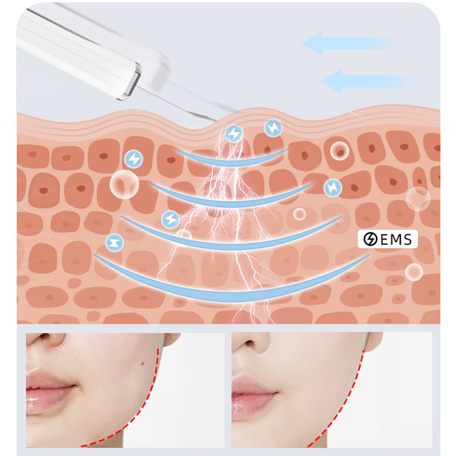 Diagramma mostra strati della pelle con dispositivo EMS. Frecce, fulmini ed esempi di pelle prima/dopo con linee rosse.