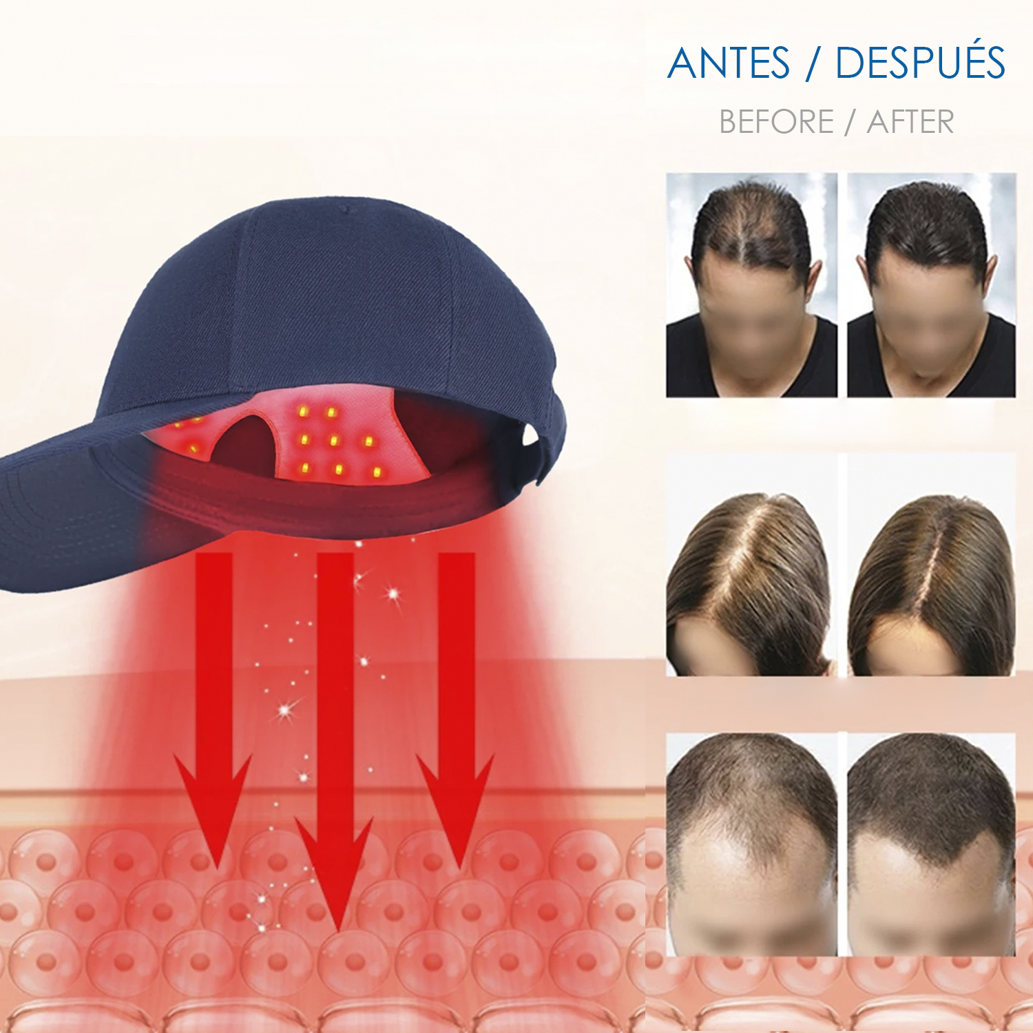 Una gorra azul con rayos de luz roja, comparando el crecimiento del cabello antes/después. Las imágenes muestran mejoras tras el uso.