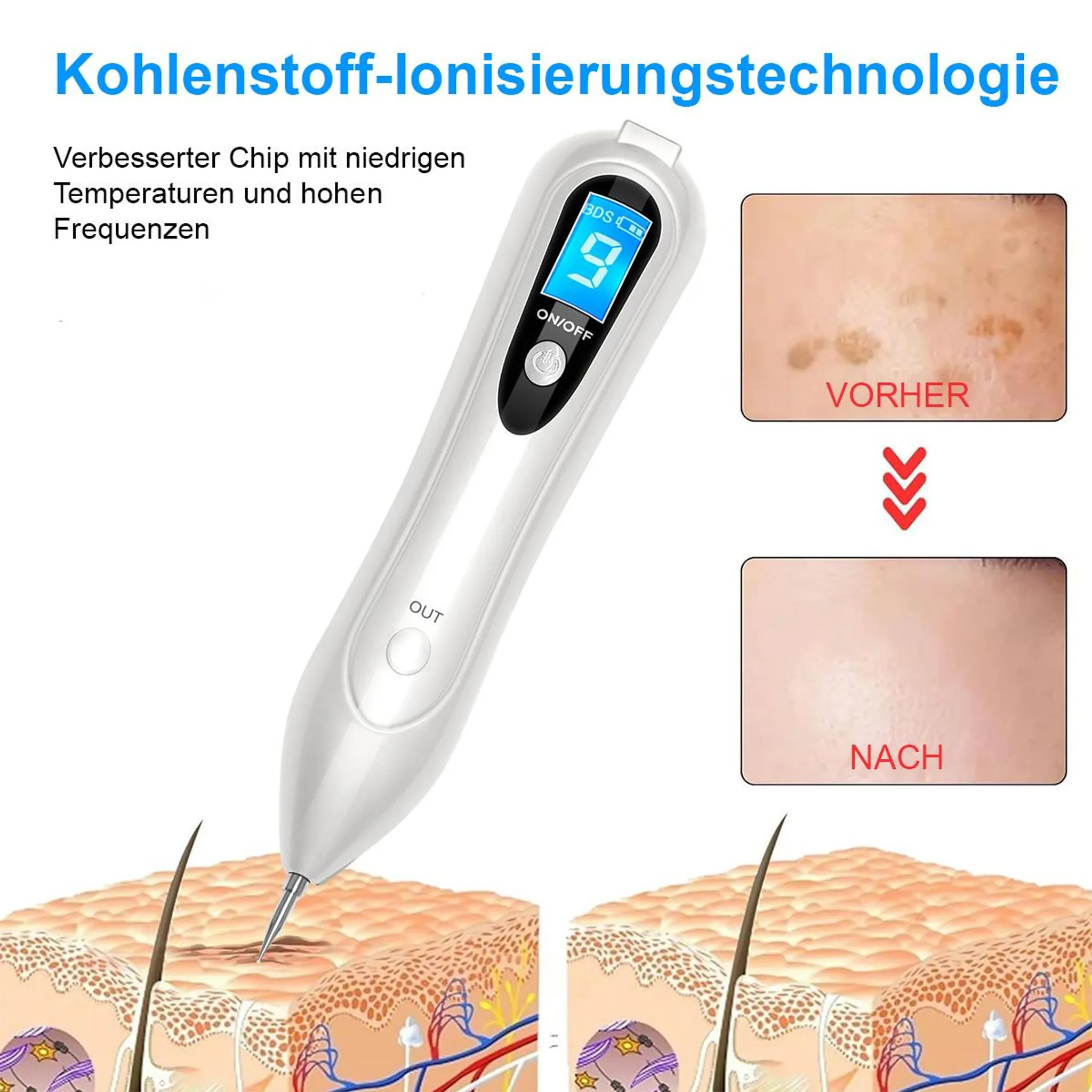 Gerät zur Hautbehandlung. Zeigt '9'. Text: 'Vorher' und 'Nach'. Diagramm der Hautschichten. Text auf Deutsch.