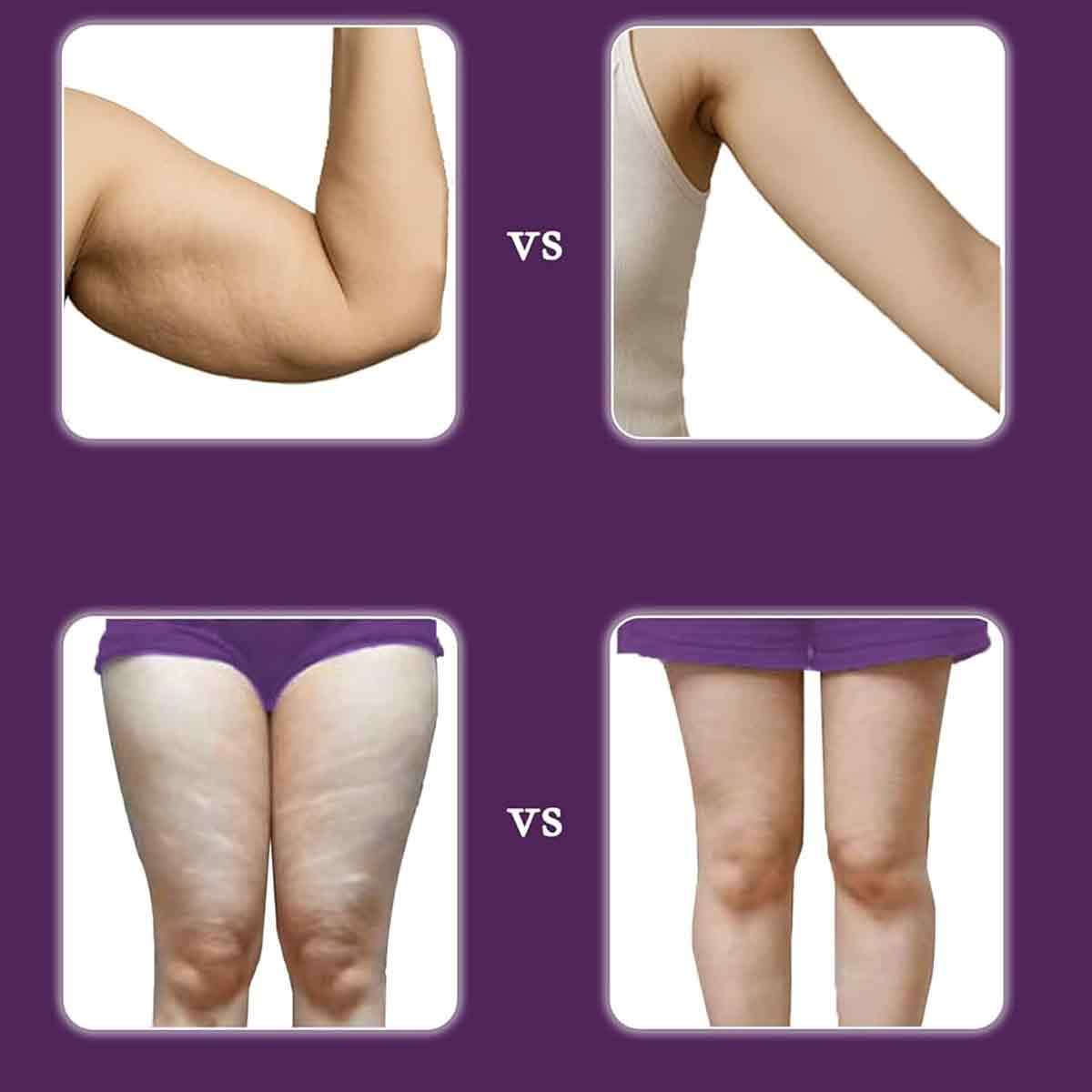 Das Bild zeigt Körperteile: Arme und Beine. Eine Seite zeigt Cellulite, die andere glatte Haut. Lila Hintergrund mit VS in Weiß.