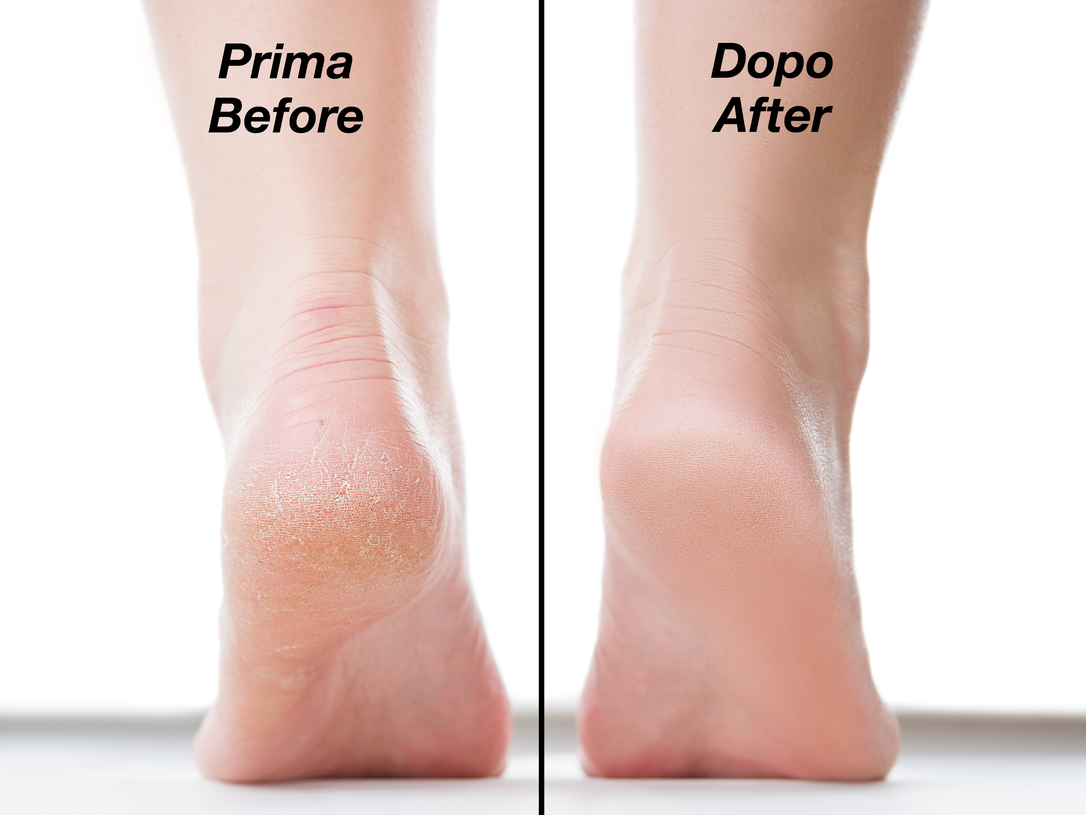 L'immagine mostra due piedi. Prima: tallone screpolato. Dopo: tallone liscio. Testo dice 'Prima/Before' e 'Dopo/After'.
