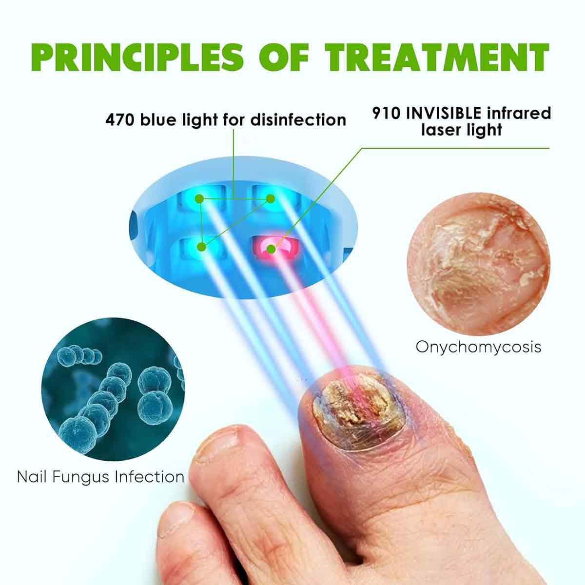 Das Bild zeigt Behandlungsprinzipien. Blaue und rote Lichtstrahlen zielen auf einen Zehennagel mit Pilz. Diagramme zeigen Nagelpilz und Onychomykose.