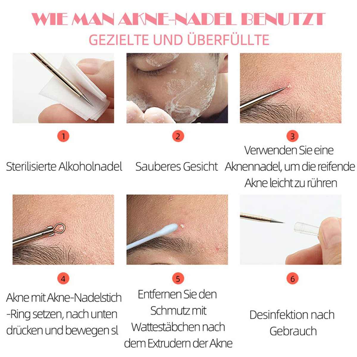 Anleitung zur Akneentfernung. Schritte: Gesicht reinigen, Nadel sterilisieren, extrahieren und desinfizieren.