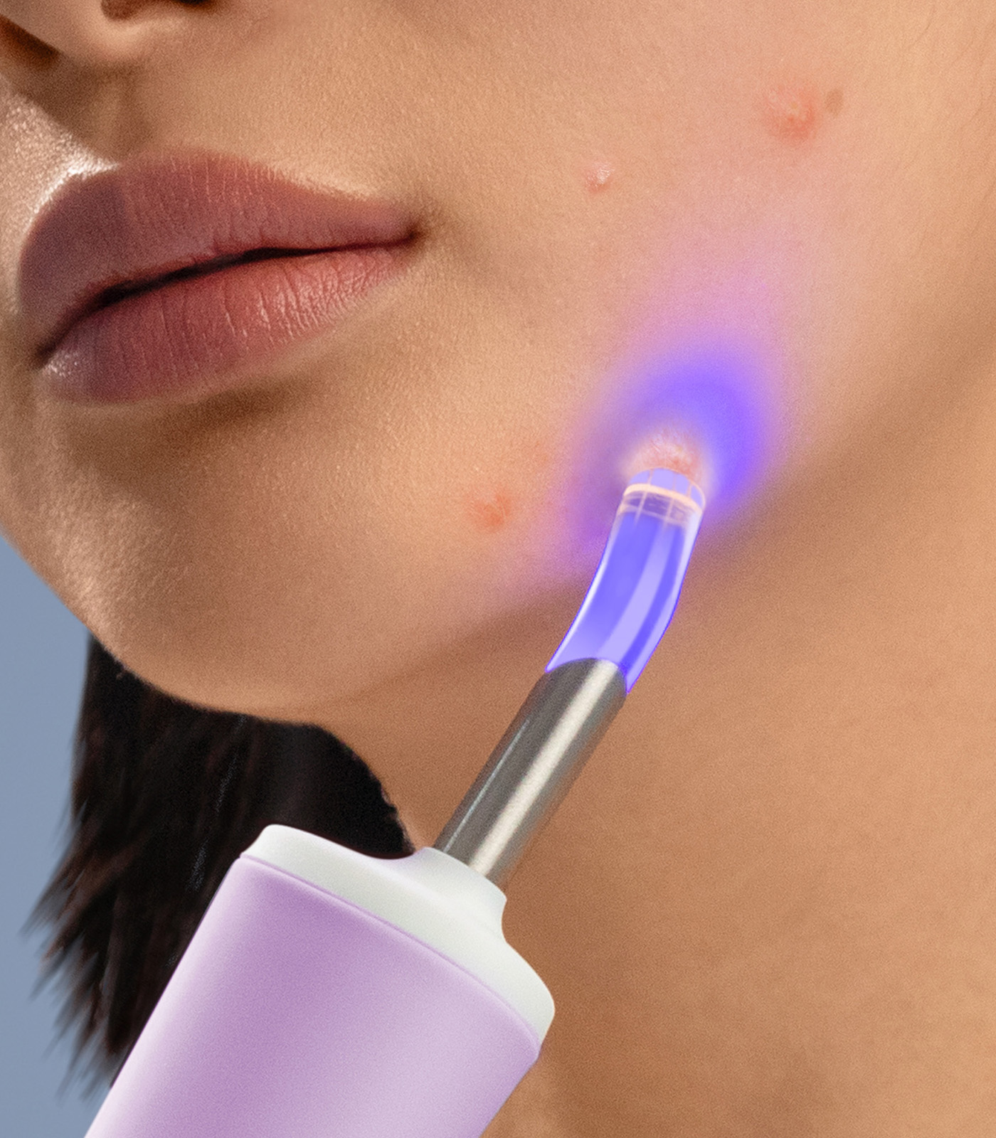 Close-up of a person's face being treated with a purple light therapy device. Skin has acne and device is near a blemish.