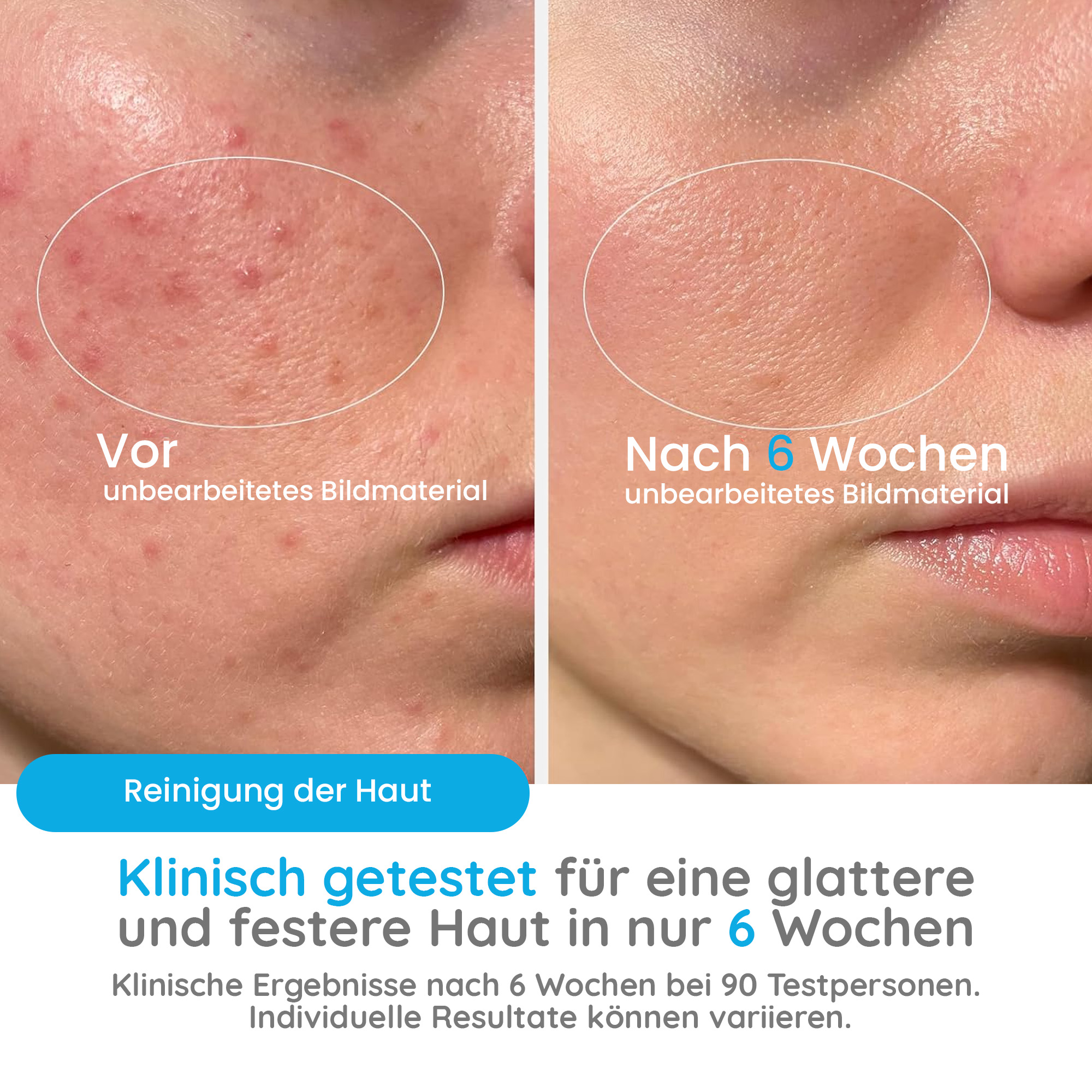 Hautbilder nebeneinander. Links Akne, rechts glattere Haut nach 6 Wochen Anwendung. Text besagt klinische Ergebnisse.