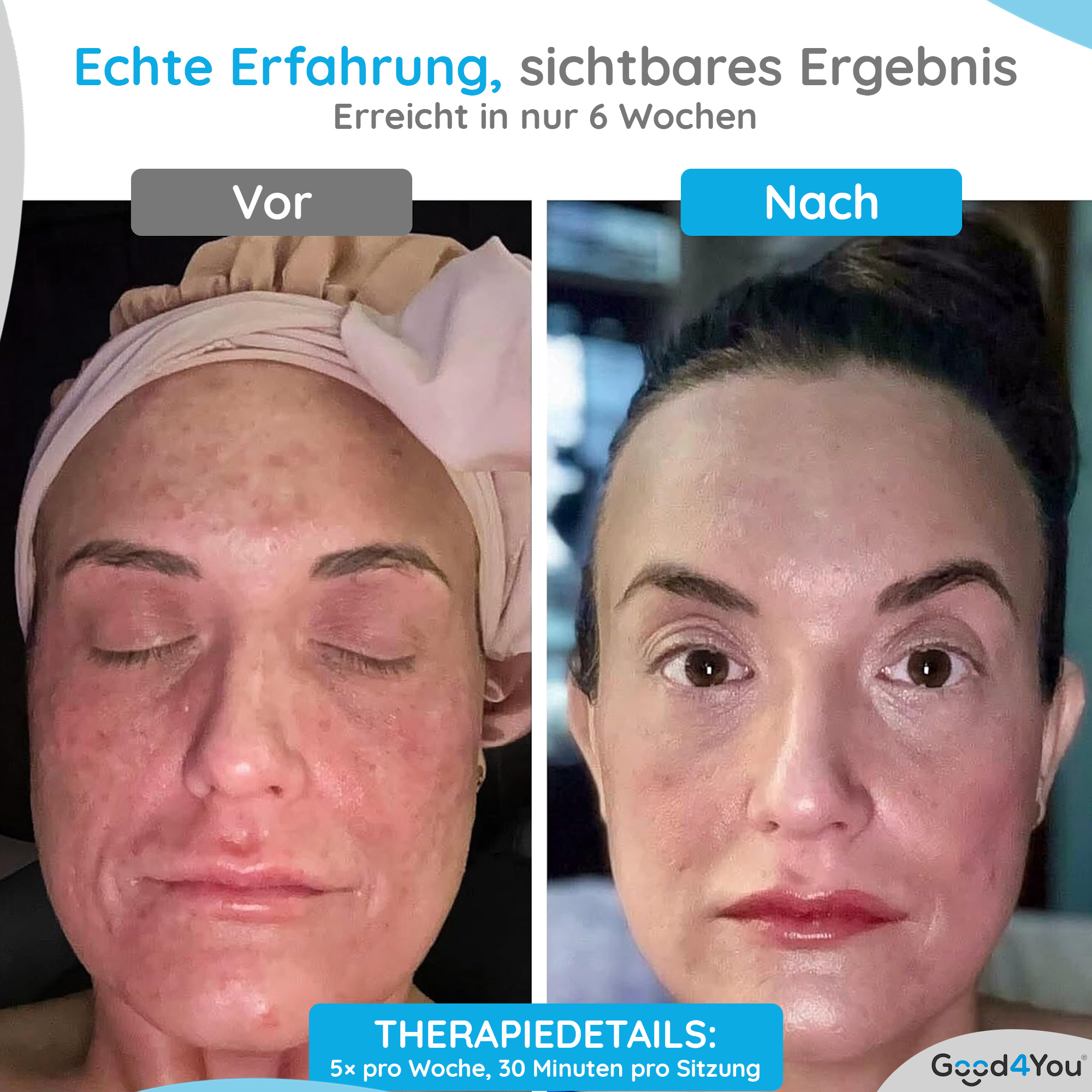 Das Bild zeigt Vorher-Nachher-Ergebnisse einer Hautbehandlung. Das linke Gesicht hat rote Haut. Das rechte zeigt glattere, klare Haut.
