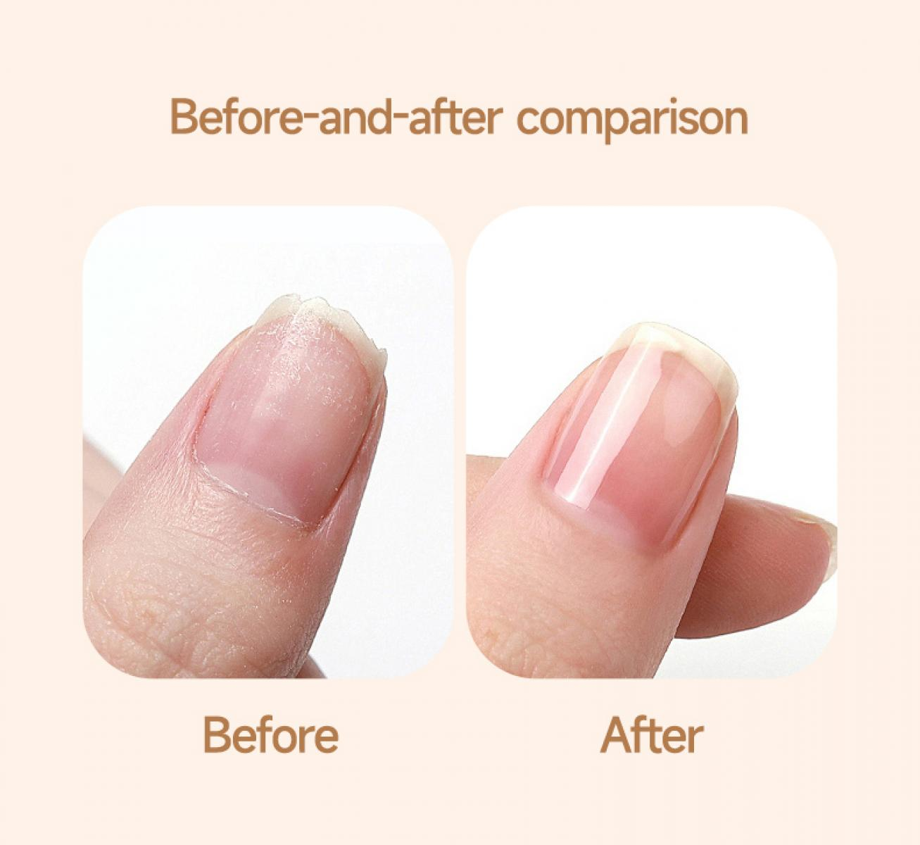 Vorher-Nachher-Vergleich eines Fingernagels. Vorher zeigt einen rauen Nagel, nachher einen glatten, glänzenden Nagel.