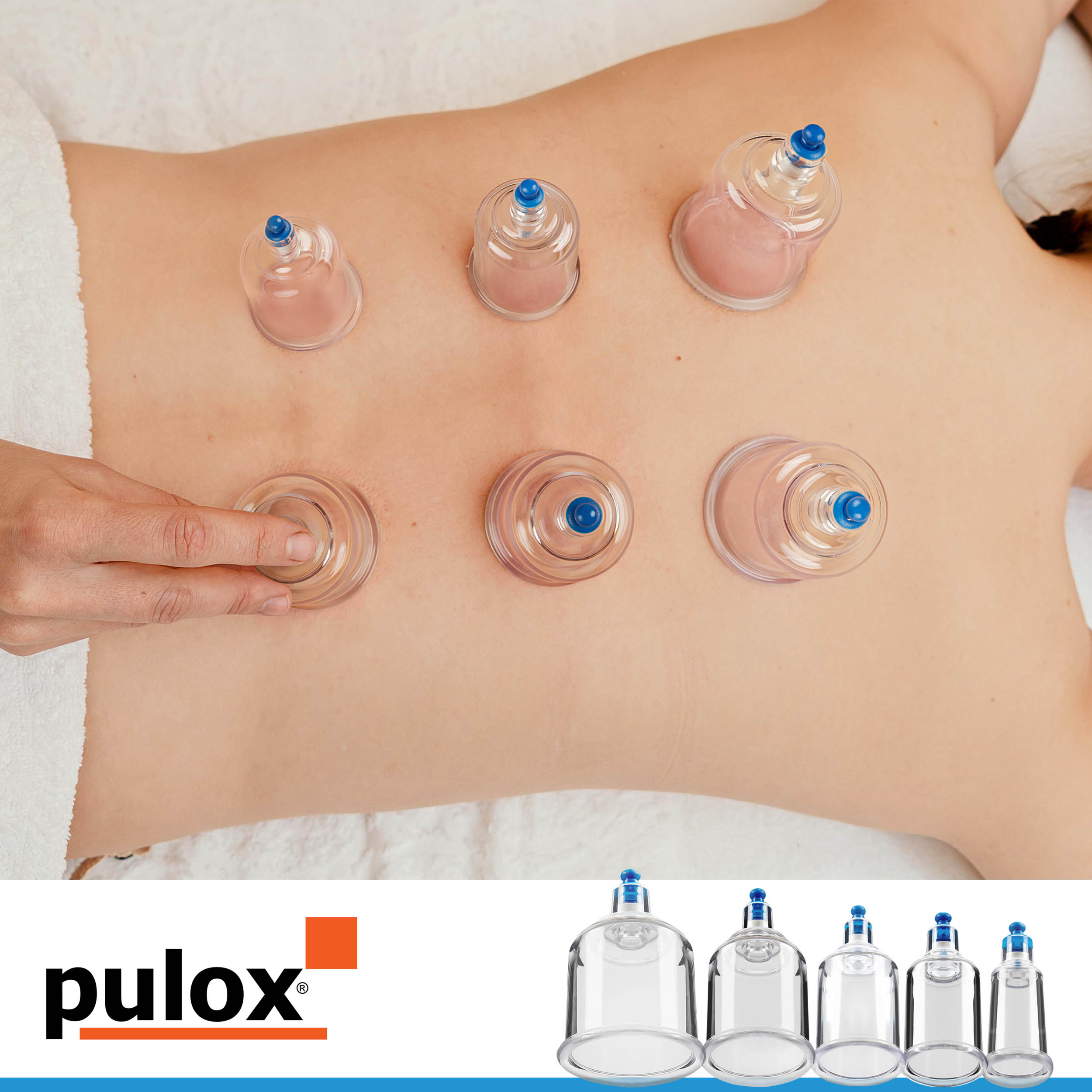 Rücken einer Person mit Vakuumbecher-Massage, die Cups sind transparent.