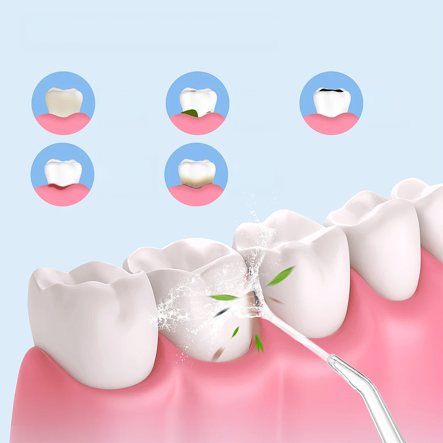 Idropulsore pulisce denti, mostra stadi di salute dentale da pulito a cariato.