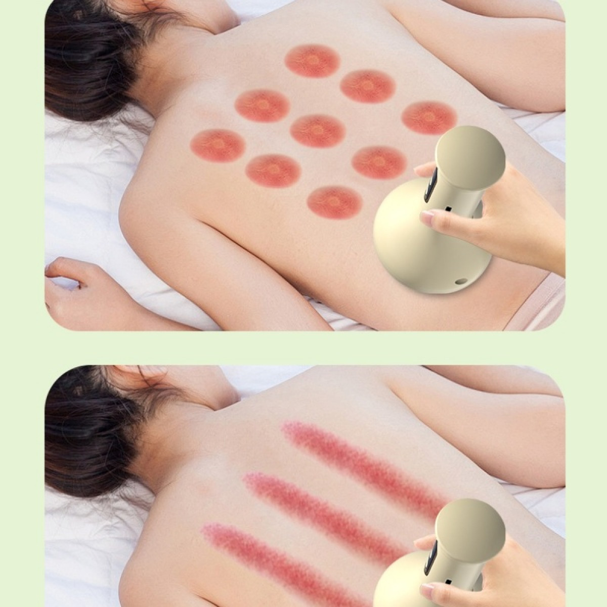Dwa obrazy pokazują terapię bańkami na plecach osoby. Góra: czerwone okrągłe ślady. Dół: czerwone liniowe ślady.