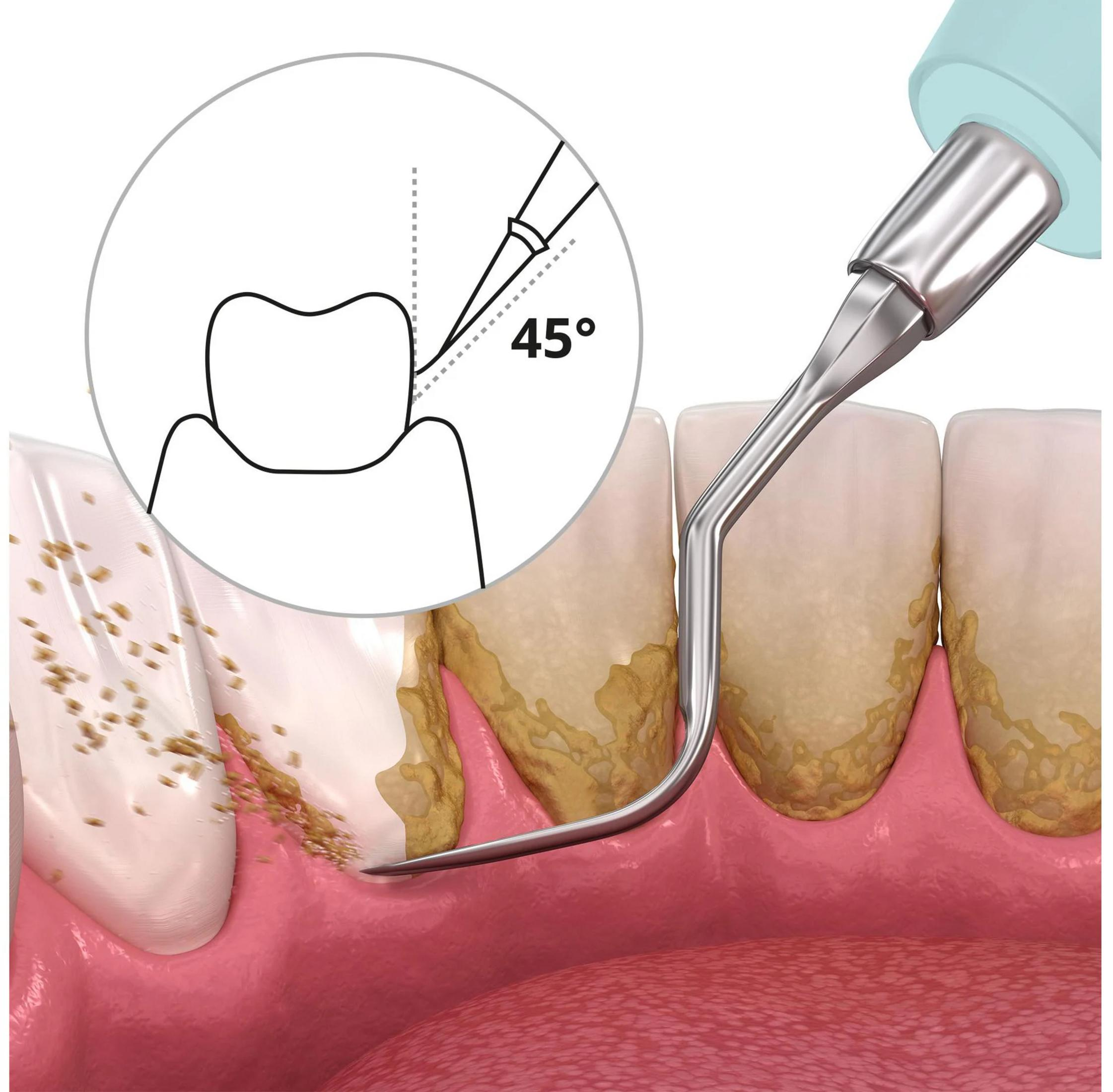 Limpiador dental elimina sarro en ángulo de 45° bajo la encía.