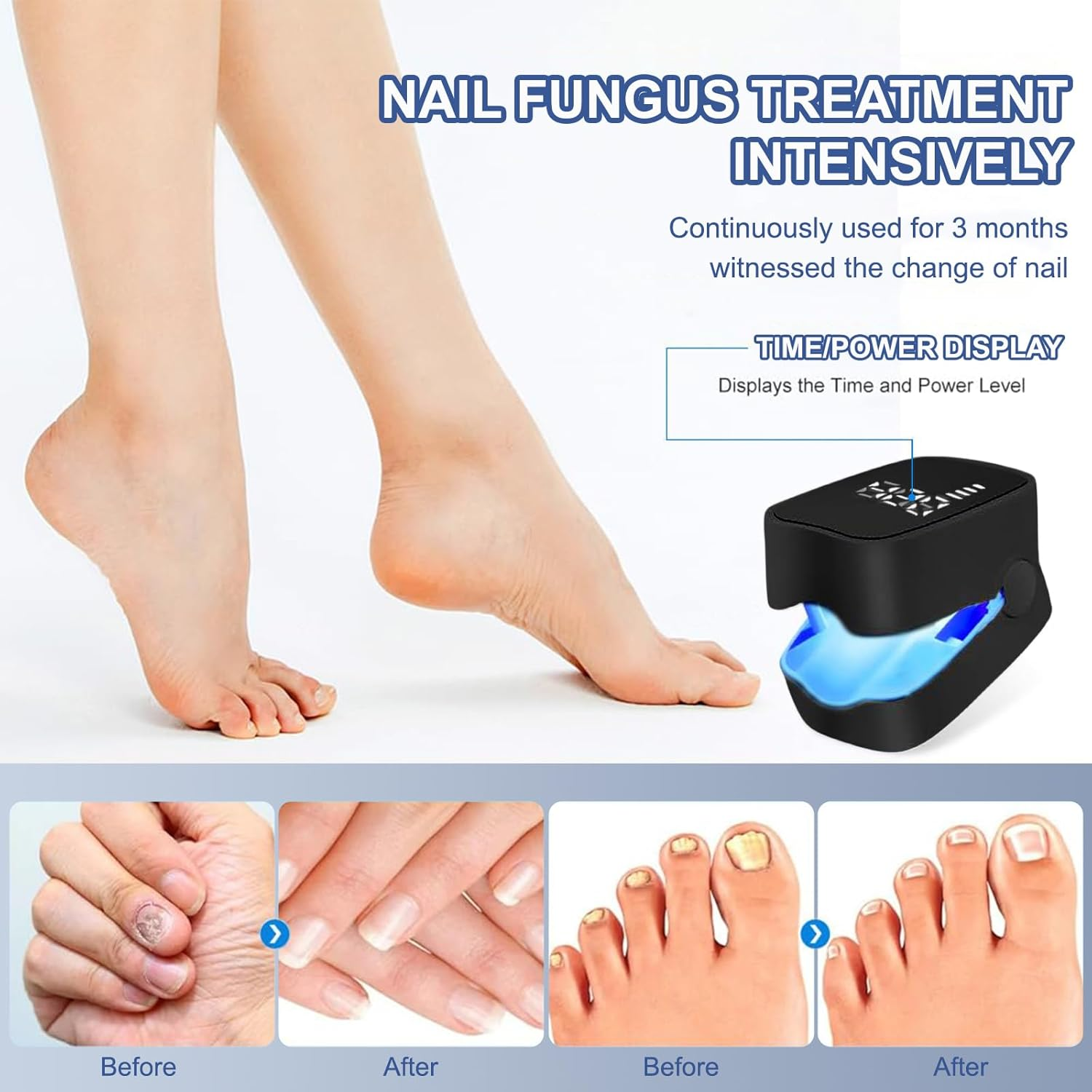 Vorher/Nachher-Bilder von Nagelpilzbehandlung mit Gerät.