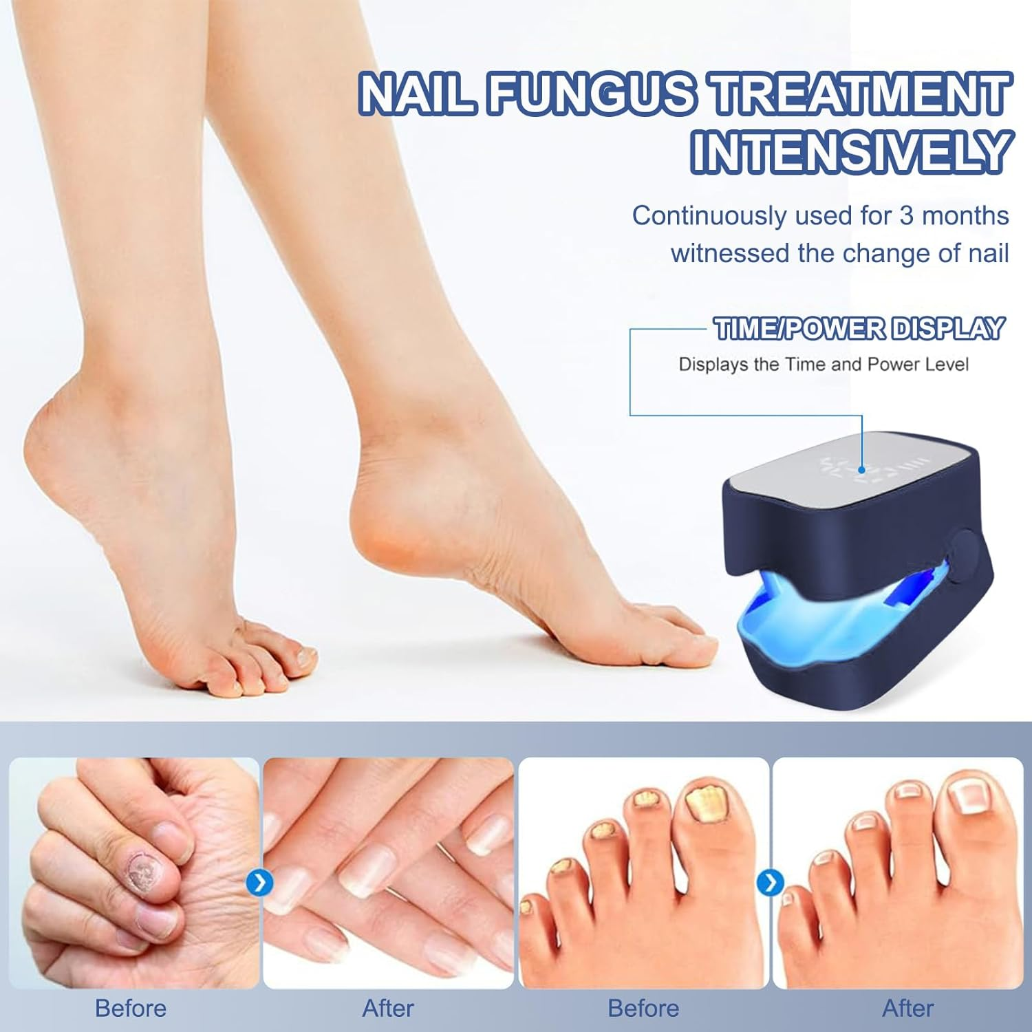 Füße und Nägel: Vorher-Nachher-Vergleich einer Nagelpilzbehandlung mit einem Gerät.
