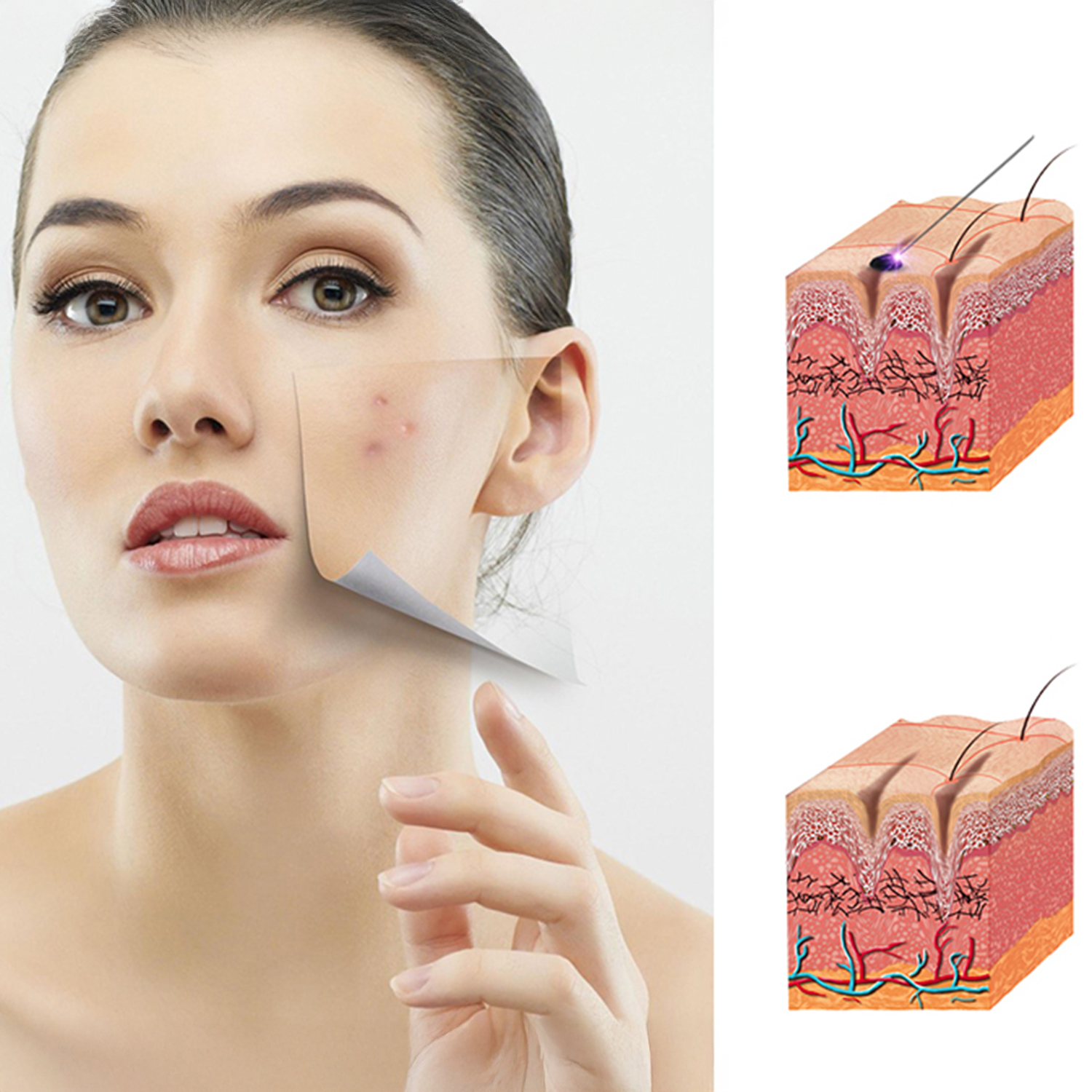 Viso di donna con strati di pelle, che mostrano acne e trattamento dei pori.