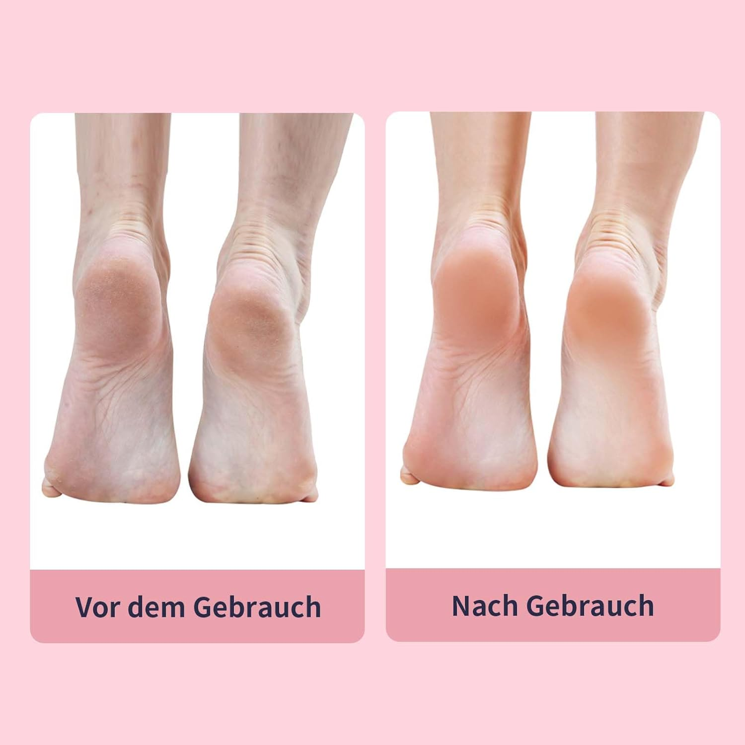 Vorher-Nachher-Vergleich von Füßen mit trockener, rissiger Haut und glatter Haut.