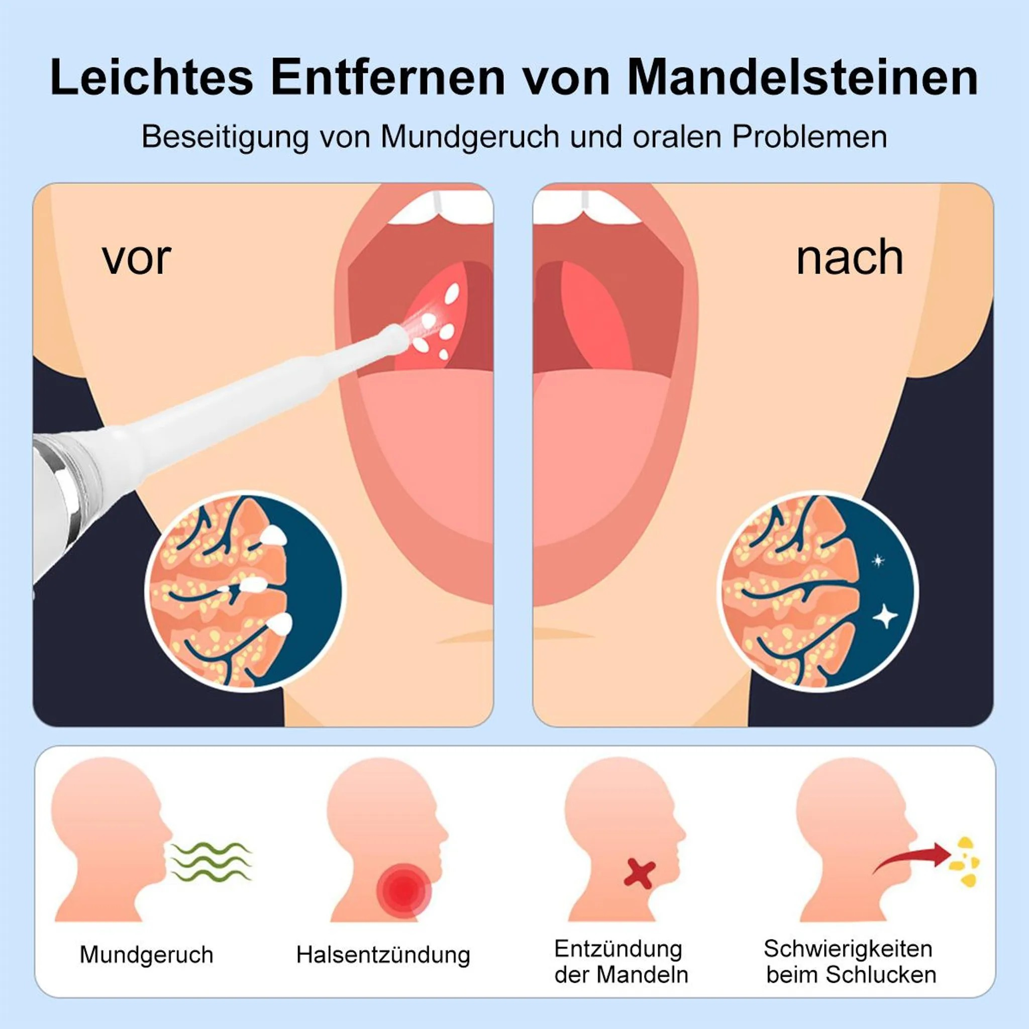 Vorher/Nachher-Vergleich der Mandelsteinentfernung mit detaillierten Illustrationen.