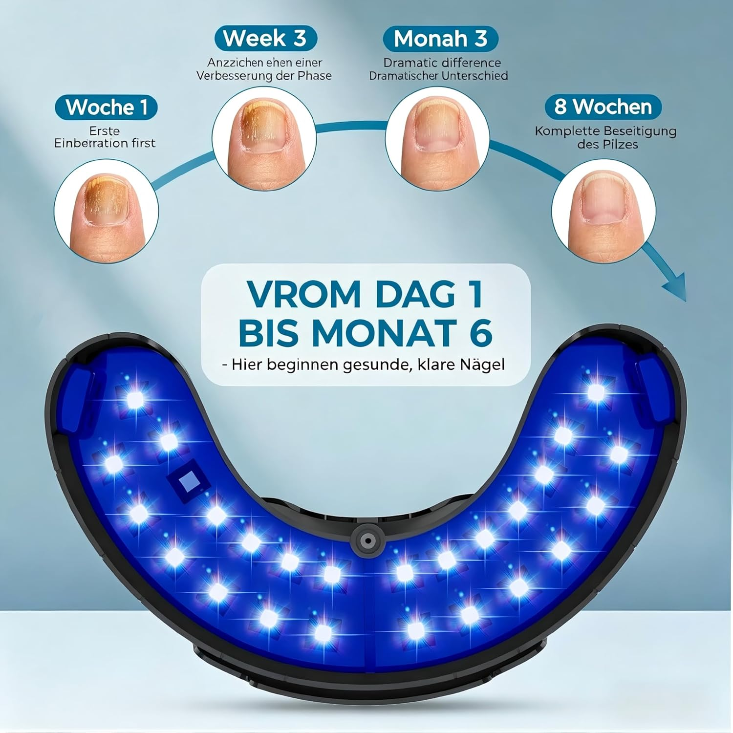 Verlauf einer Nagelpilzbehandlung von Woche 1 bis Monat 6 mit einem blauen LED-Gerät.