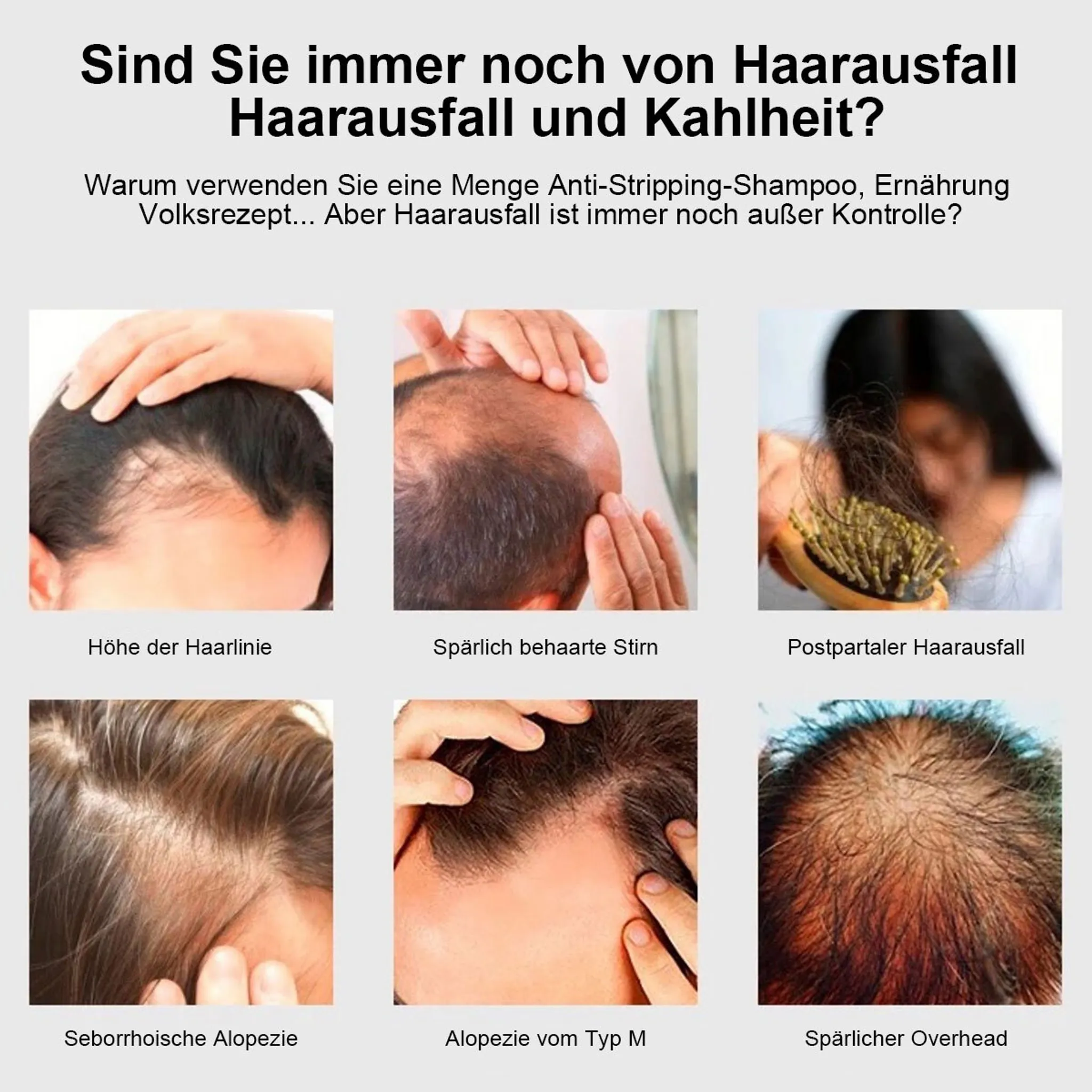 Sechs Bilder zeigen verschiedene Formen von Haarausfall und kahlen Stellen.