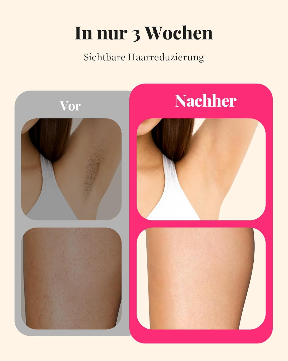 Vorher/Nachher Vergleich von Achsel- und Beinbehaarung, die reduziert wurde.
