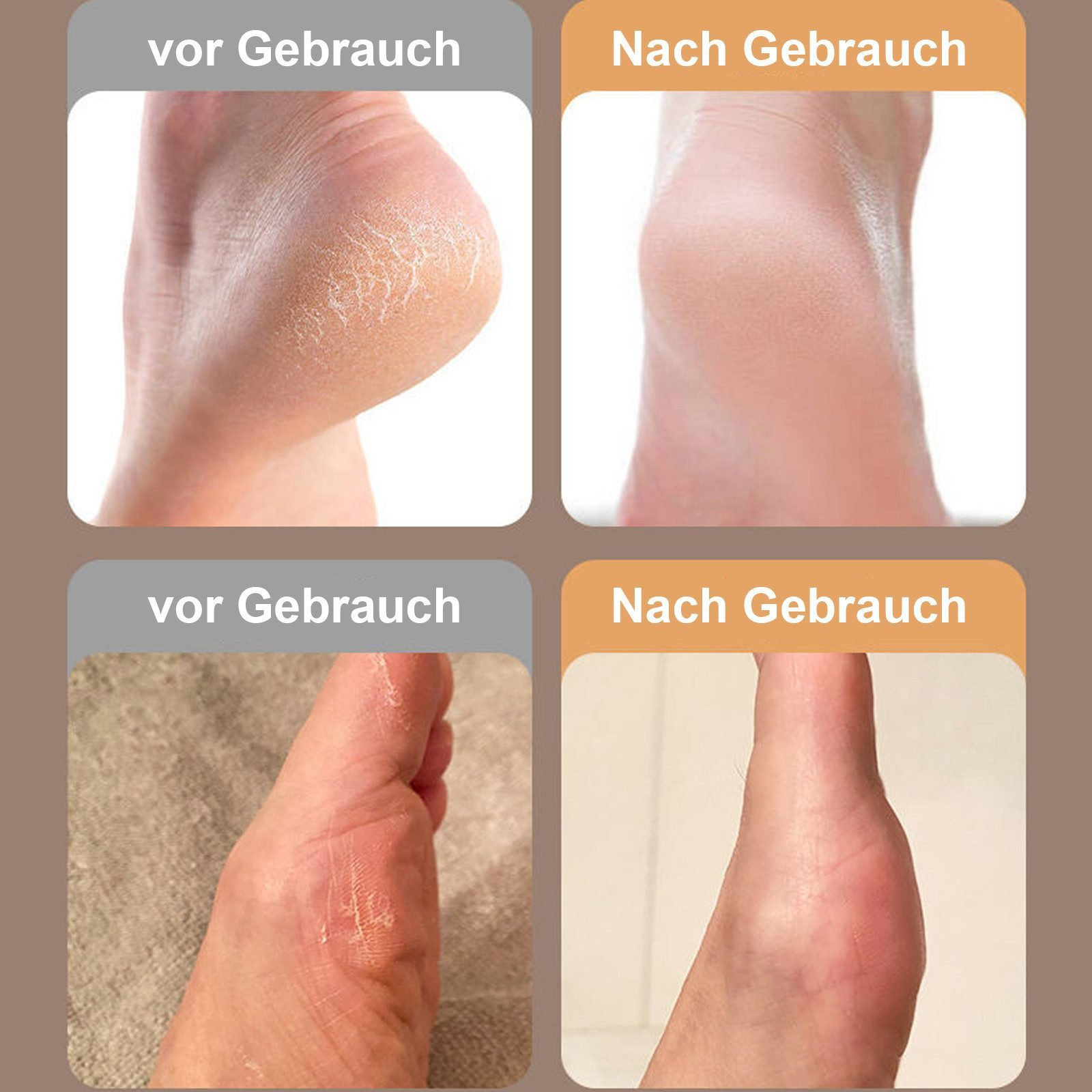 Vorher/Nachher-Vergleich von trockener Haut an Füßen.