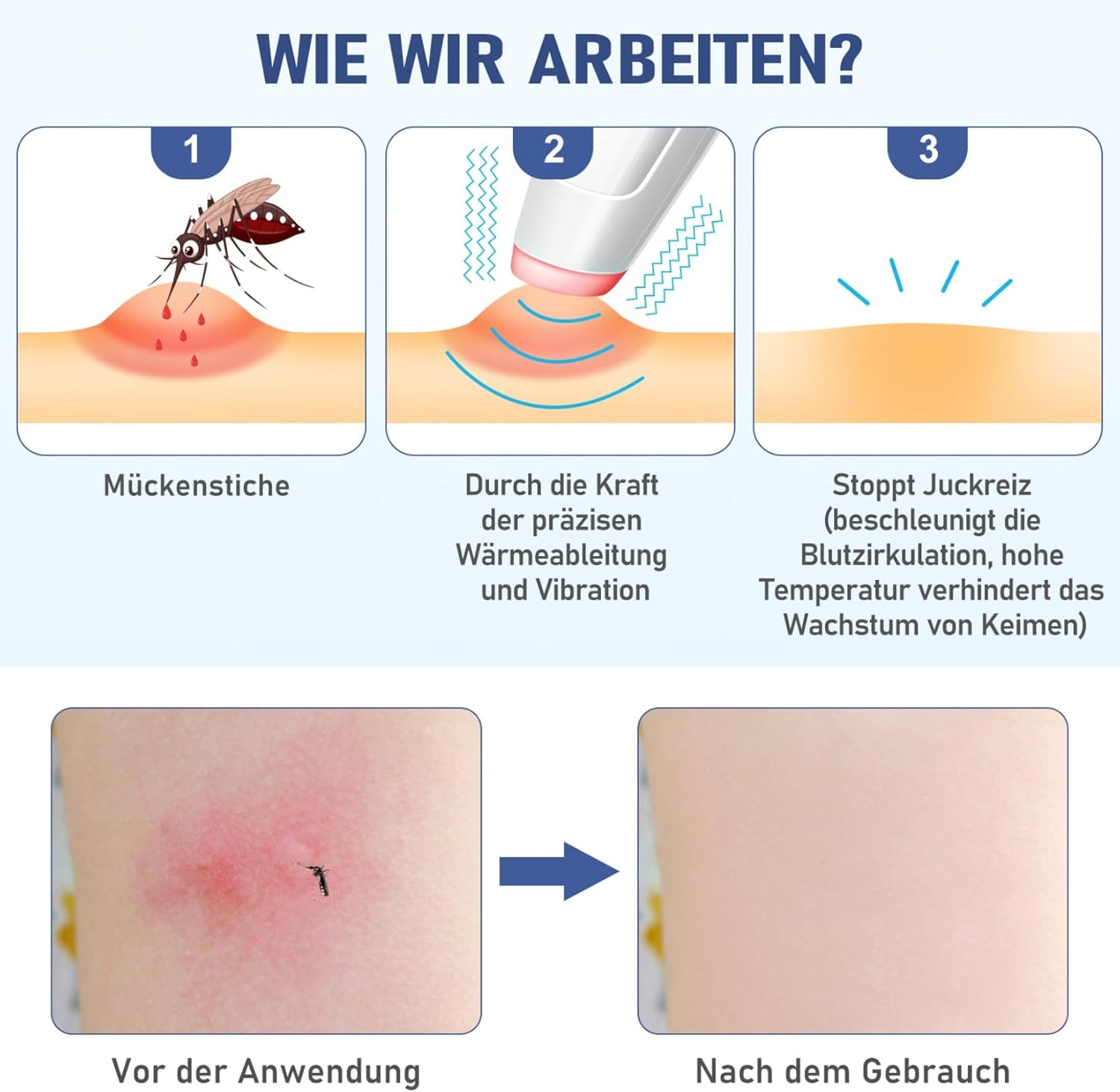 Illustrationen zeigen Mückenstiche, Behandlung mit Gerät und geheilte Haut.