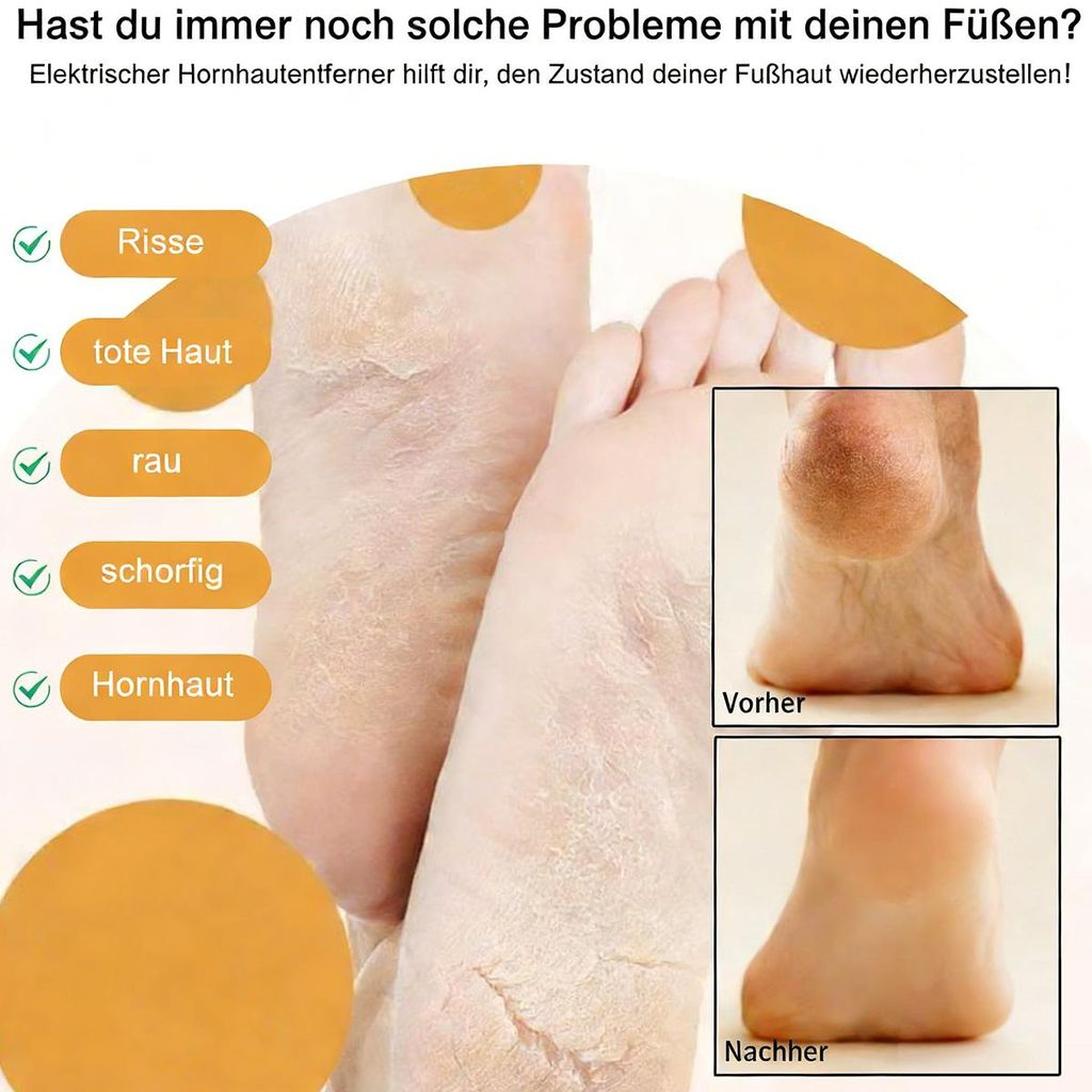 Füße mit Rissen, trockener Haut und Hornhaut. Vorher/Nachher-Bilder.