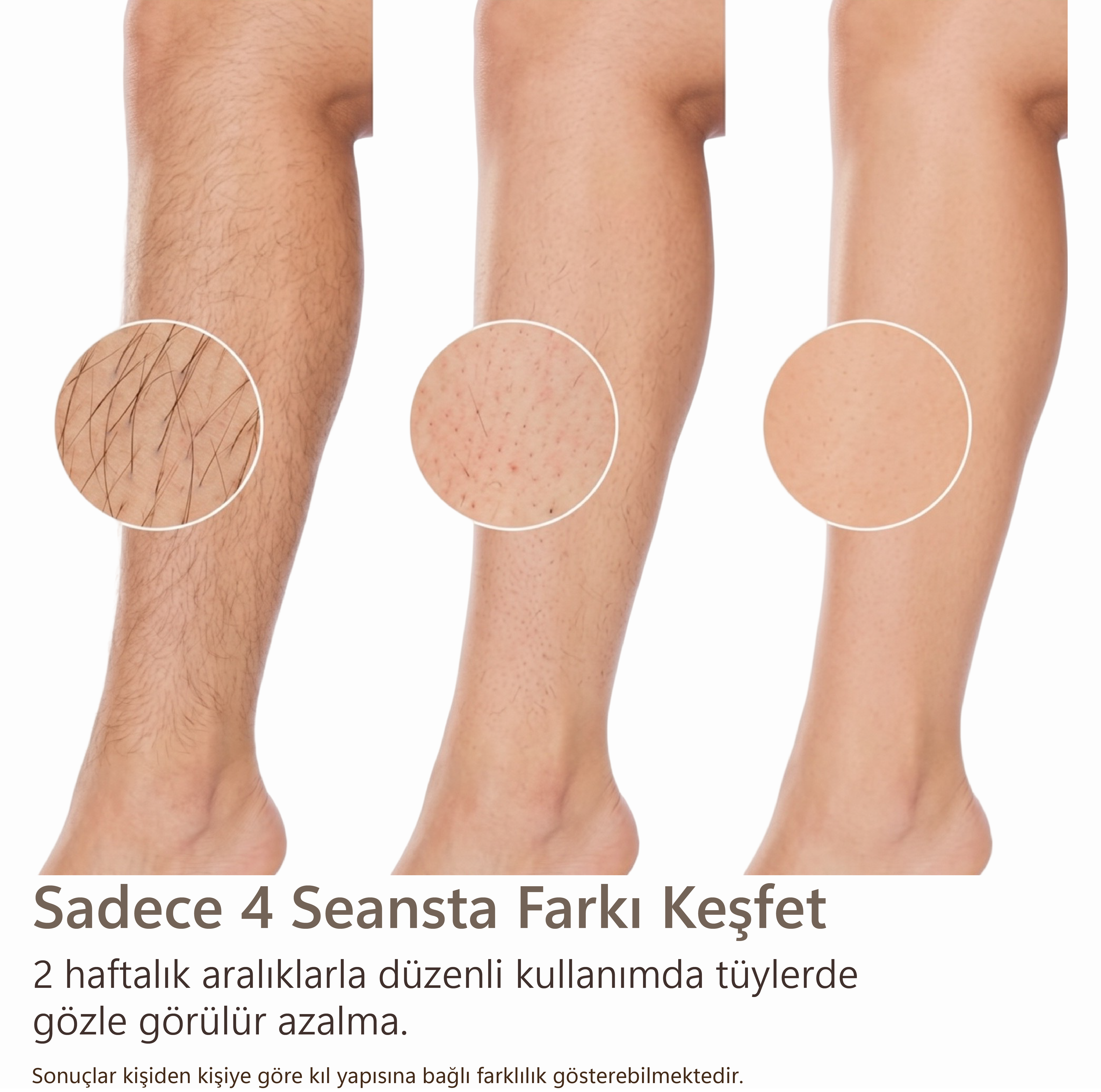 Tüy azaltma gösteren bacaklar: kullanım öncesi, sırası ve sonrası.