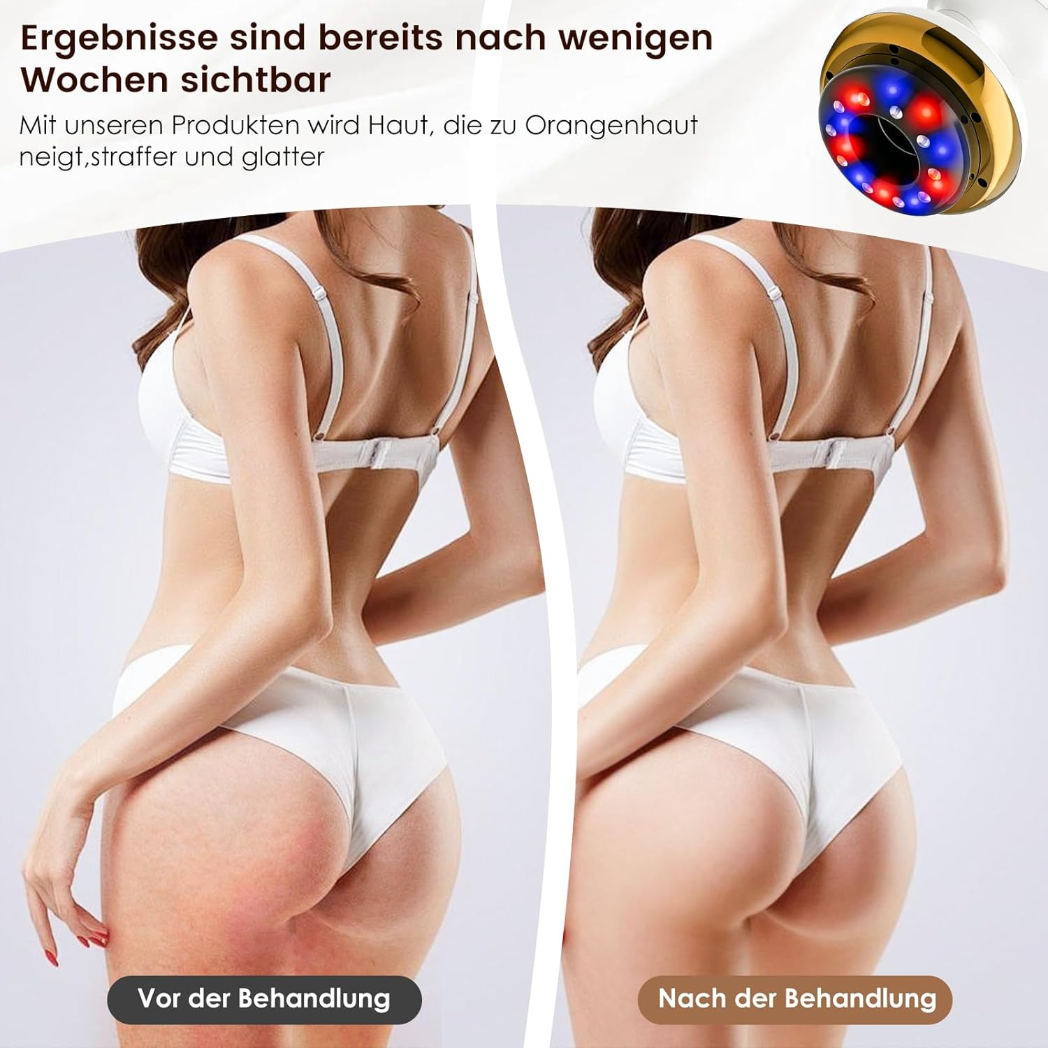 Vorher-Nachher-Vergleich der Hautbehandlung mit Cellulite-Reduktion.