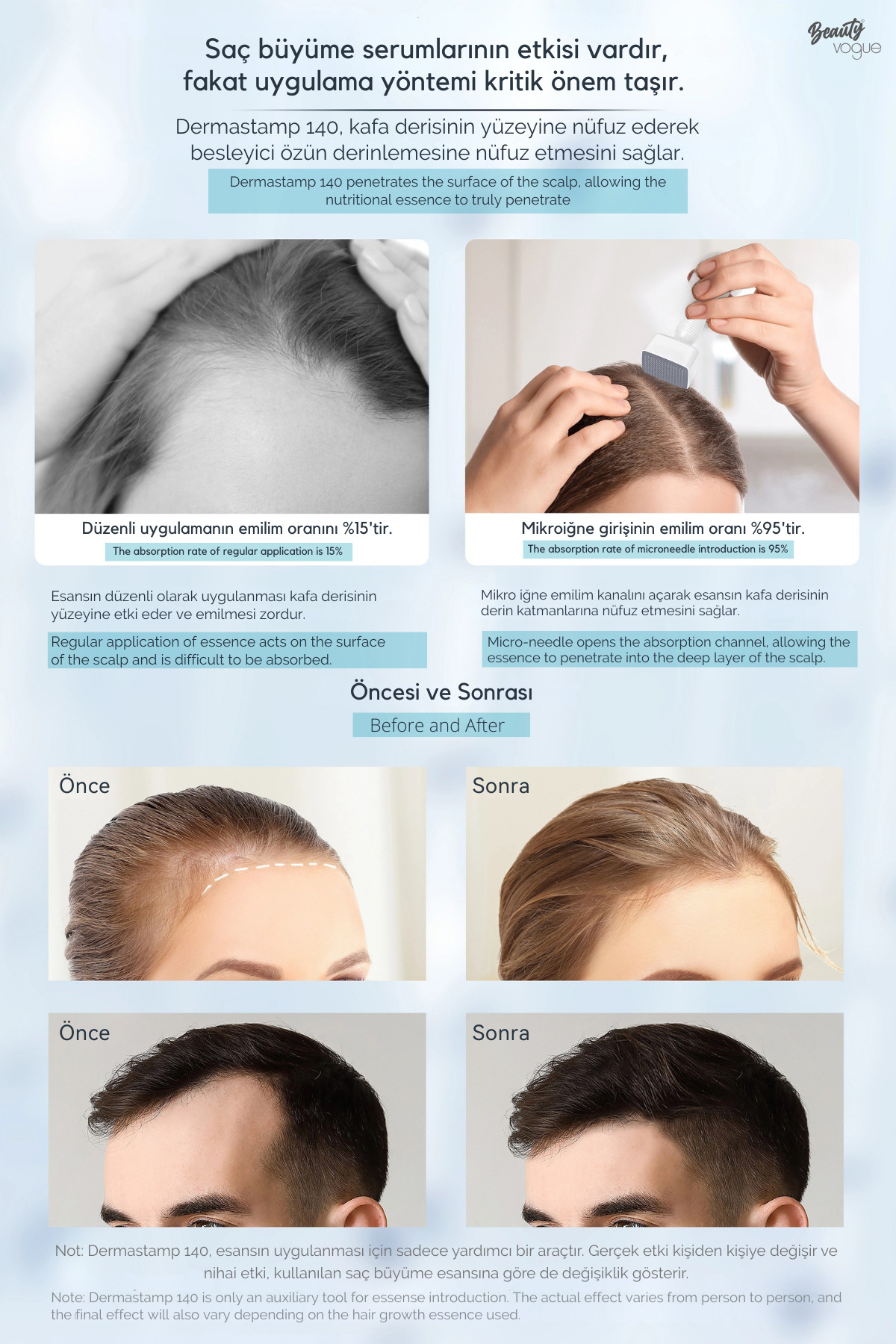 Dermastamp ile saç büyümesi öncesi ve sonrası sonuçlarını gösteren infografik.