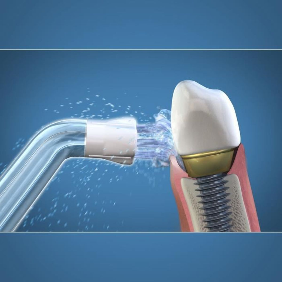 L'acqua spruzza da un ugello su un impianto dentale nelle gengive.