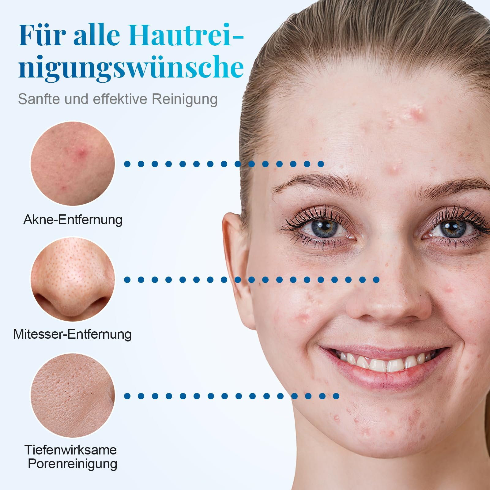 Gesicht einer Frau mit Akne und Diagramme, die Hautbereiche für Akne-, Mitesser- und Porenreinigung zeigen.