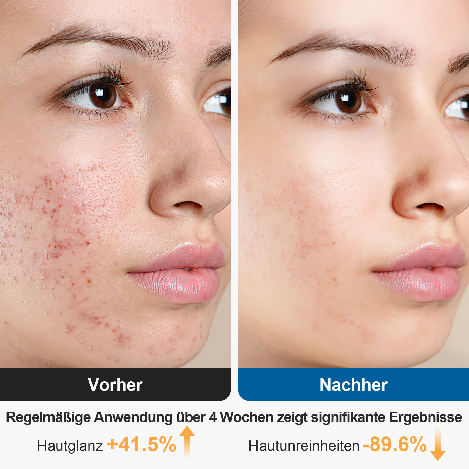 Vorher-Nachher-Vergleich einer Gesichtshaut mit verbesserter Textur nach vier Wochen.