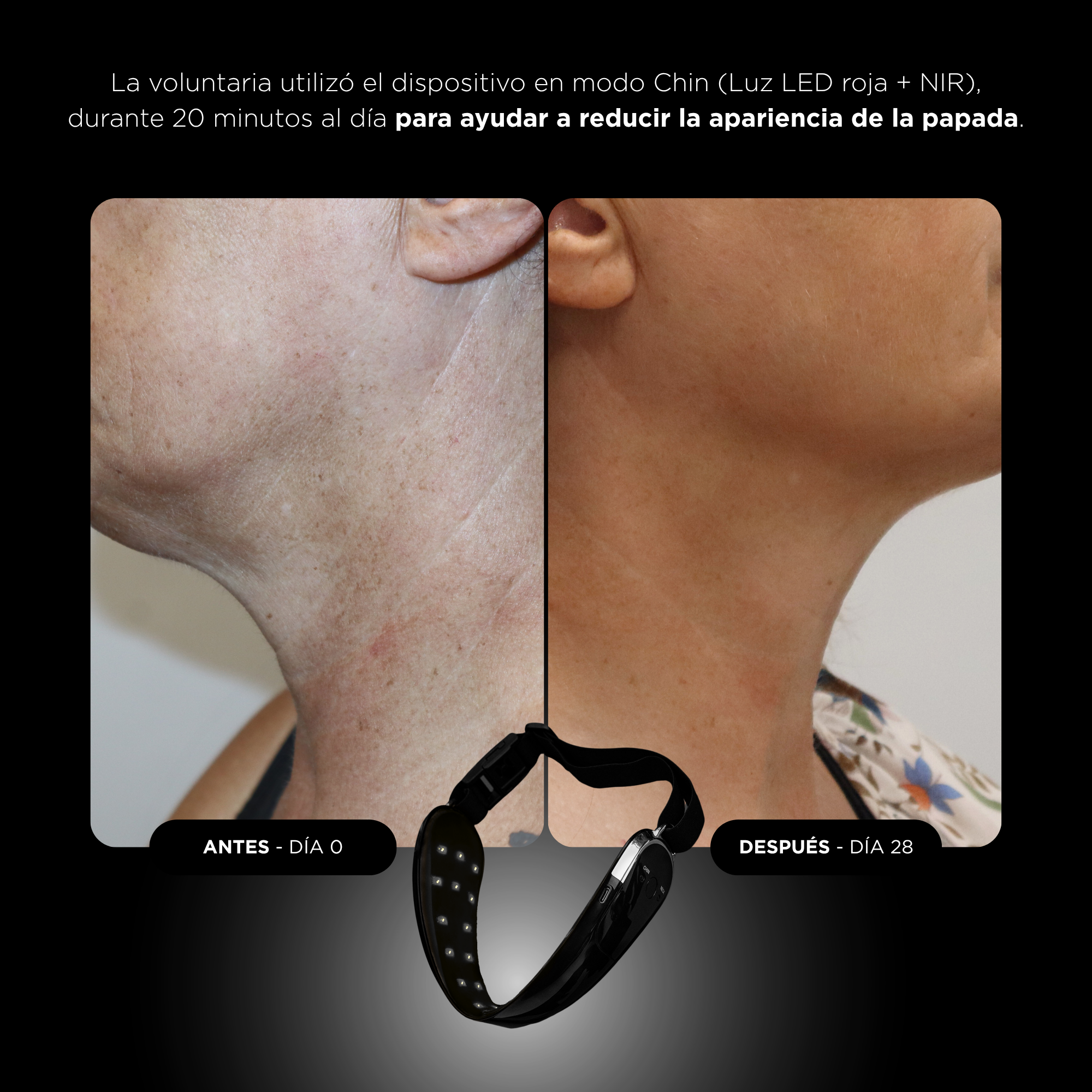 Comparación de antes y después del cuello de una mujer que muestra la reducción de la papada usando un dispositivo.