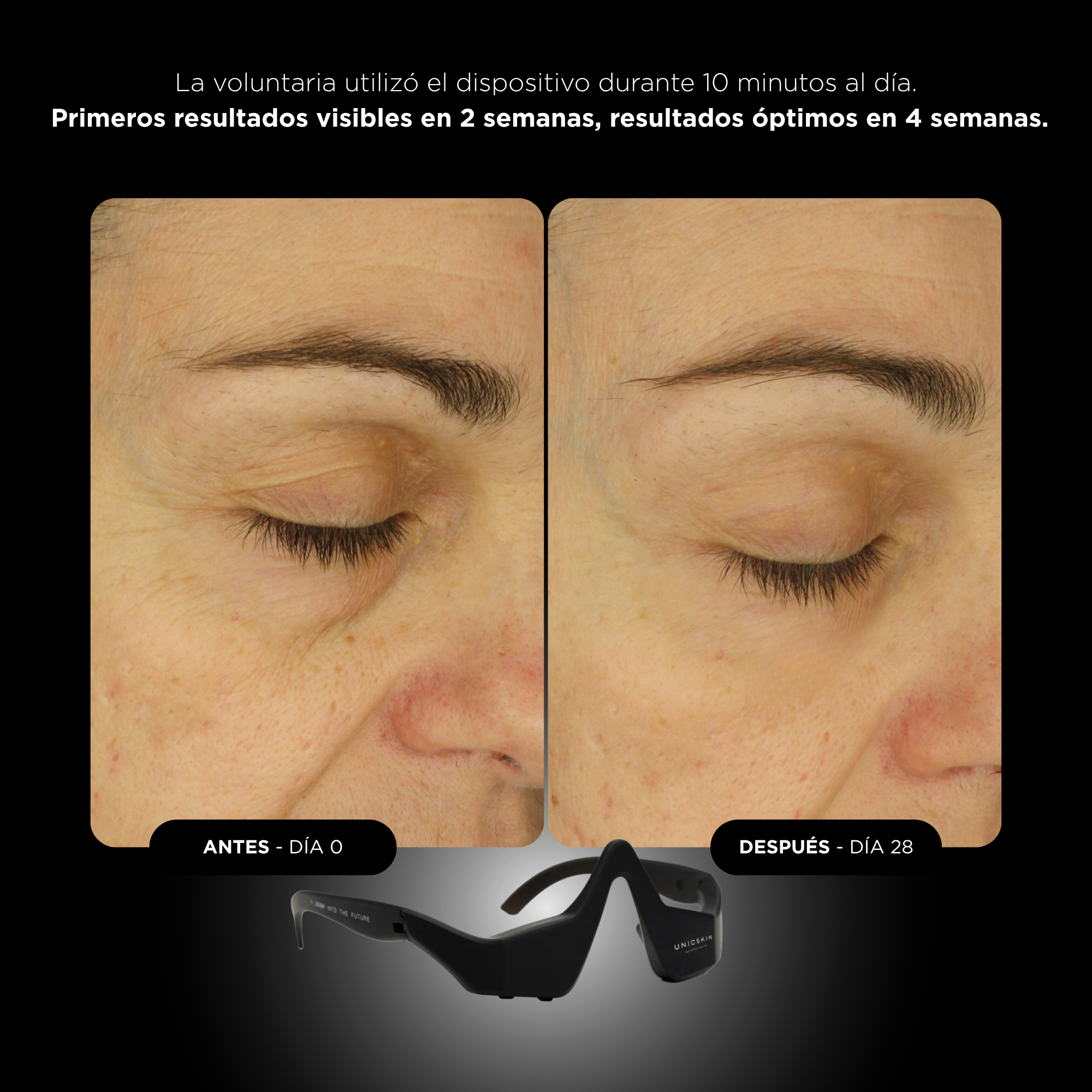 Comparación de la piel alrededor del ojo antes y después de 28 días usando un dispositivo LED negro.