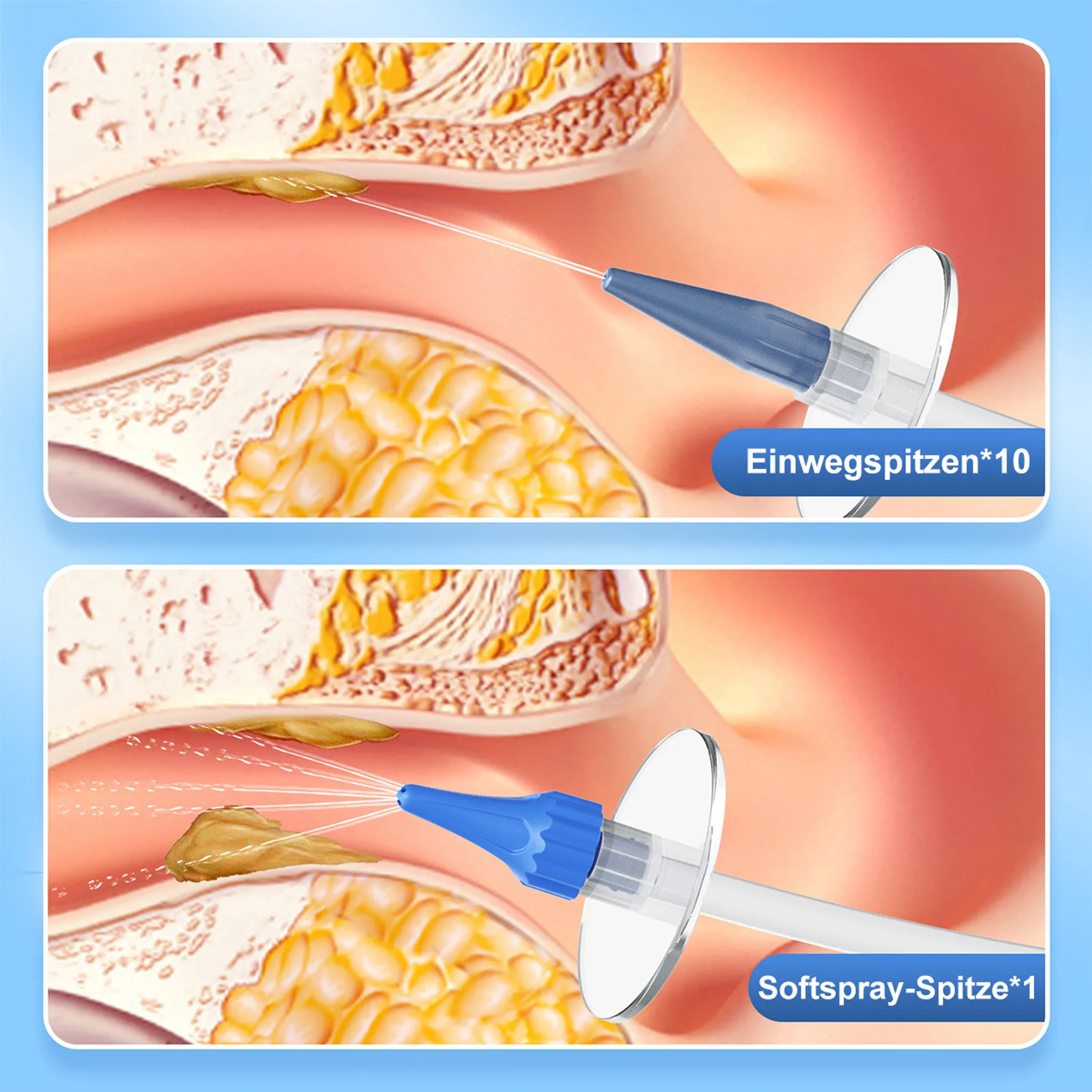 Medizinische Illustration zeigt Ohrenreinigung mit einer Einwegspitze und einer Softspray-Spitze im Gehörgang.