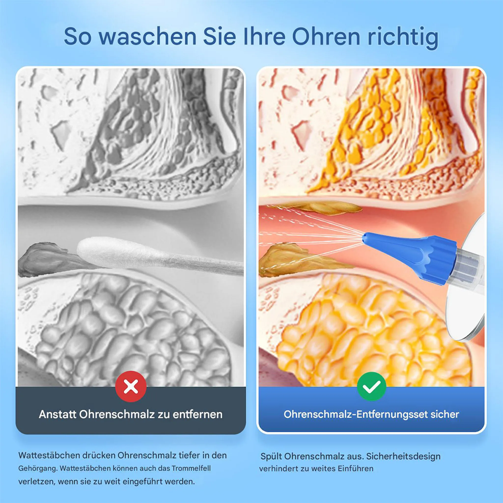 Vergleich von Q-Tip, der Ohrenschmalz tief drückt, mit einem sicheren Ohrenschmalz-Entfernungsset mit Wasserspray.