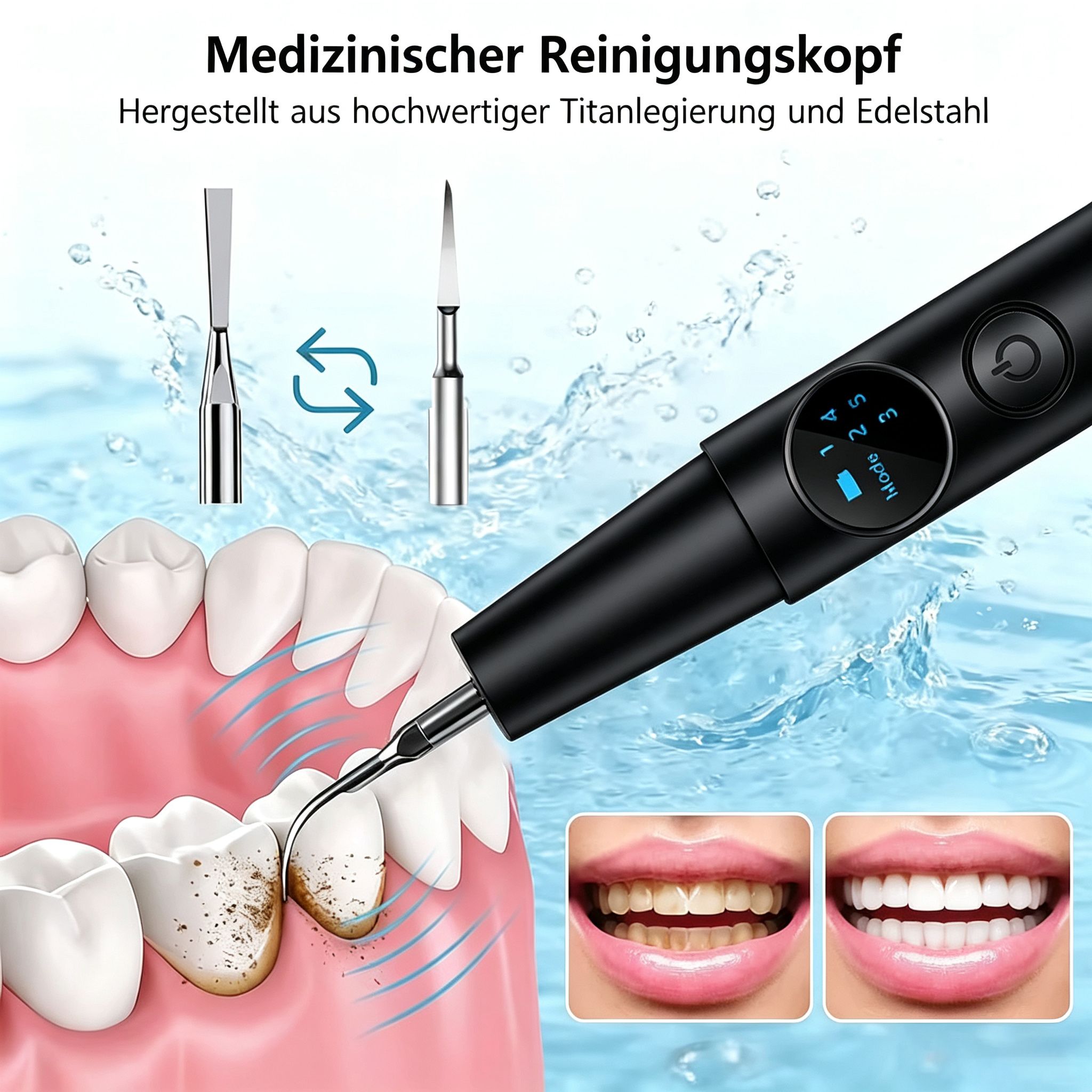 Ein dentaler Zahnreiniger entfernt Plaque von Zähnen vor einem wässrigen Hintergrund, mit Vorher-Nachher-Bildern.