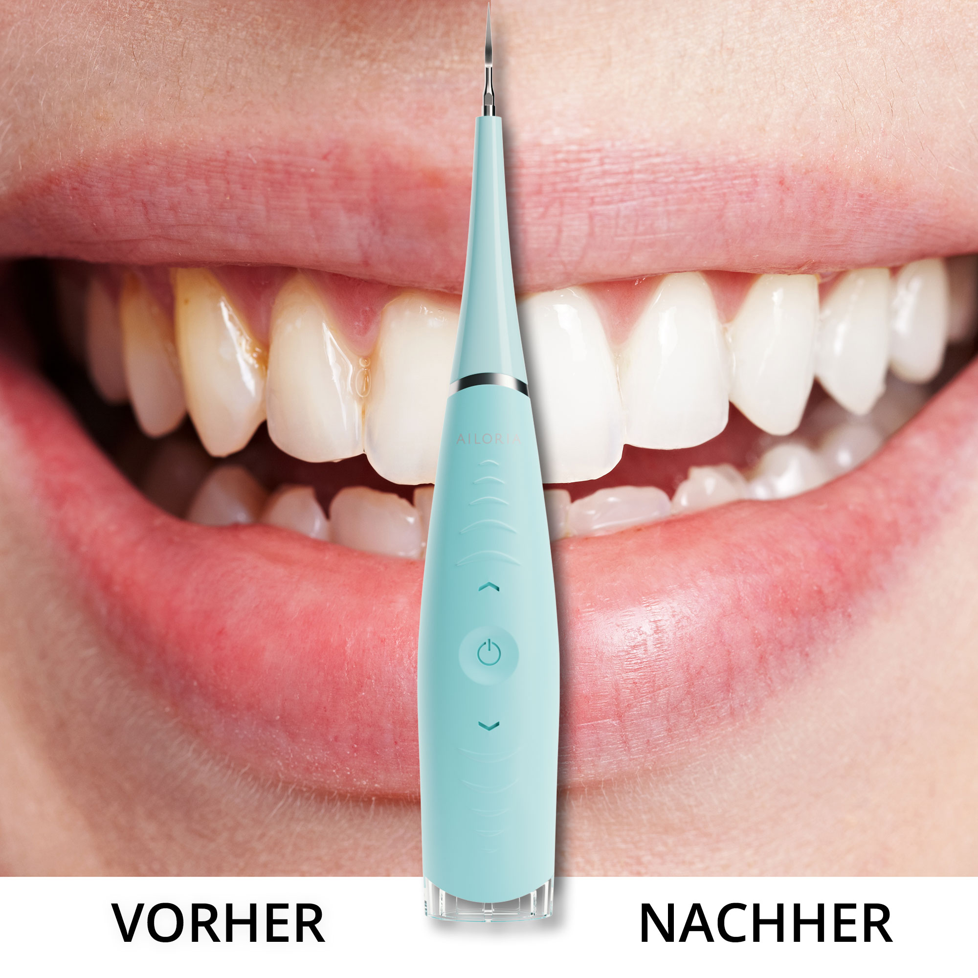 Dientes antes y después de la limpieza, usando un dispositivo turquesa.